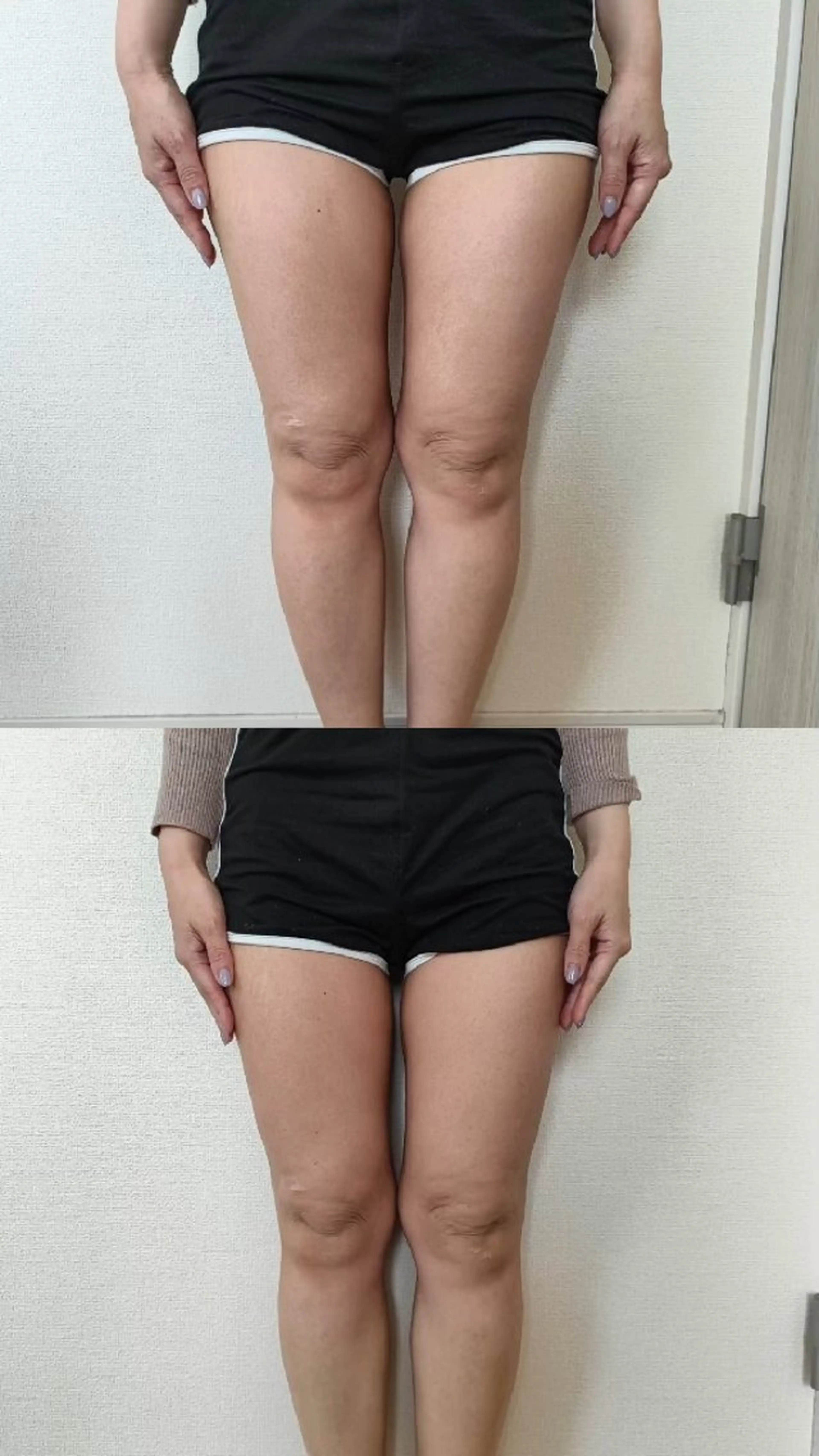 脂肪撃退キャビテーション45分(1部位)の写真