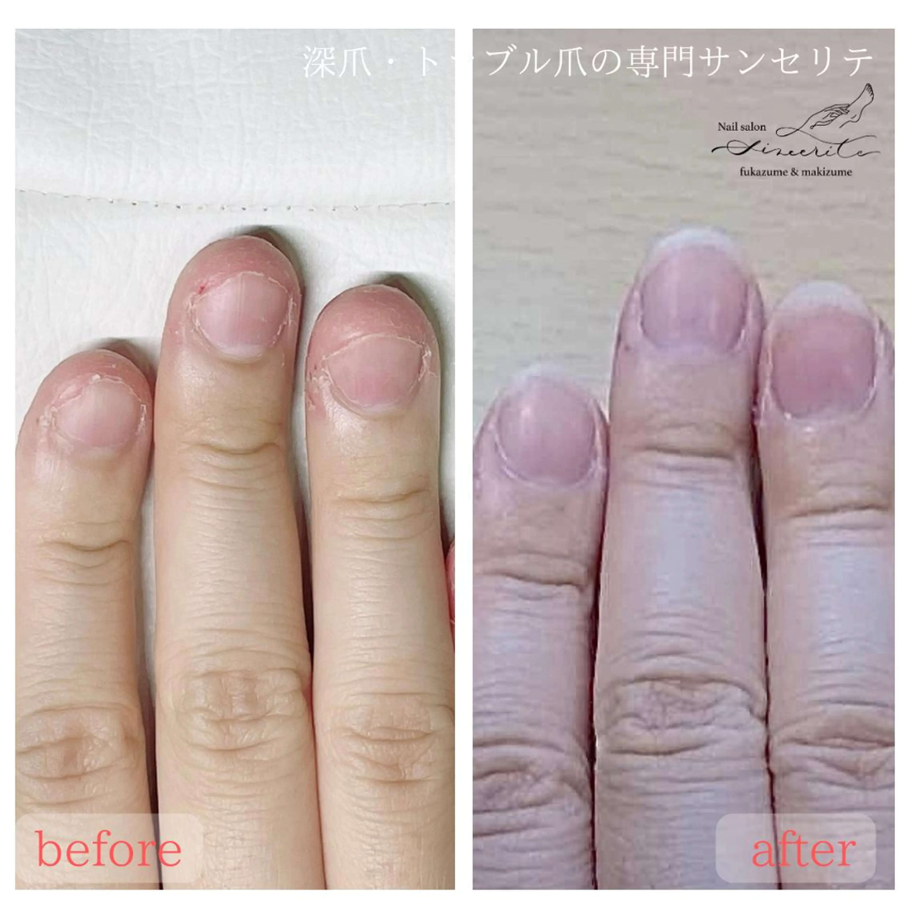 ネイル 深爪・巻き爪 専門サンセリテのネイルデザイン