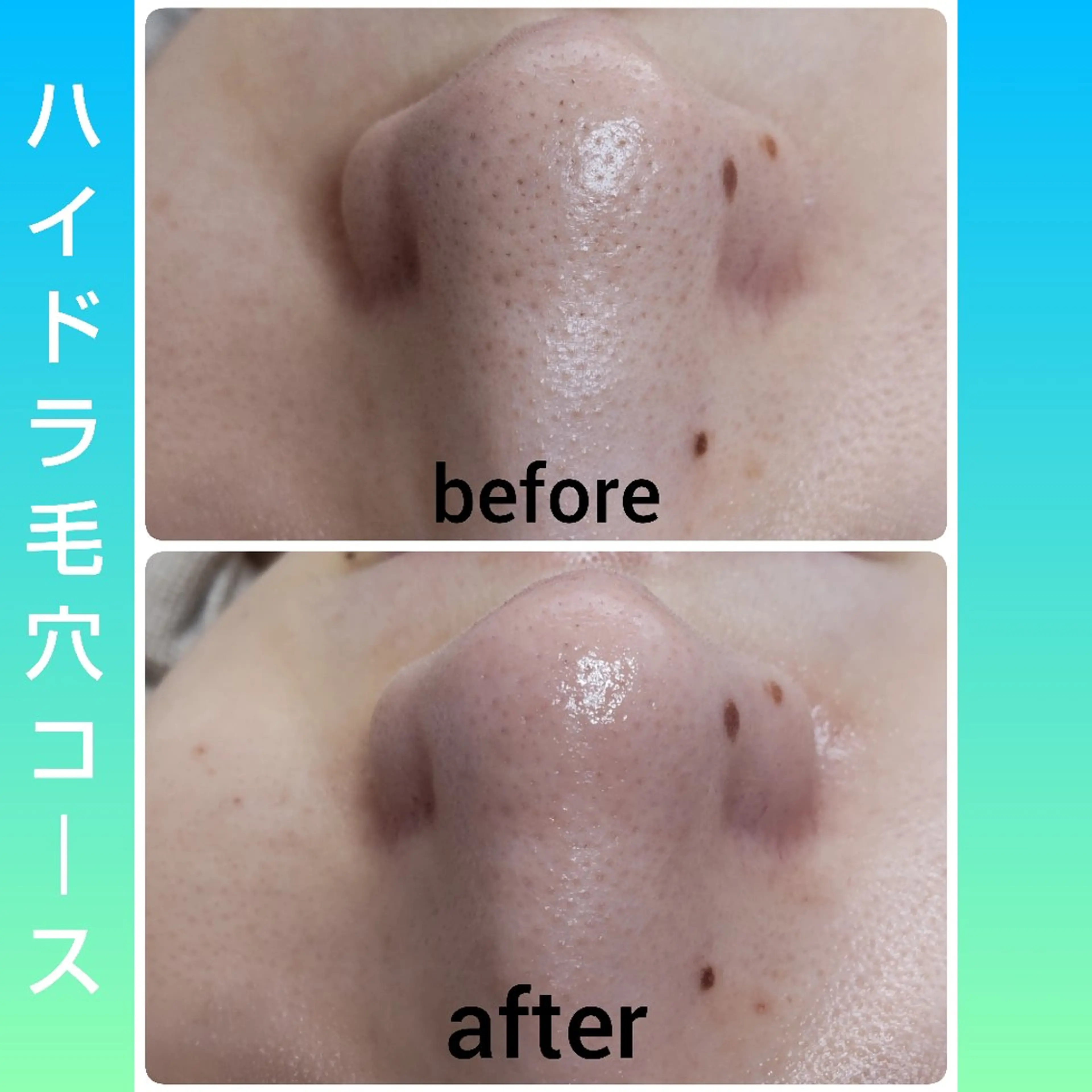 角質・毛穴洗浄🌼 脱毛🌸嶋津弘美のエステ・リラクイメージ