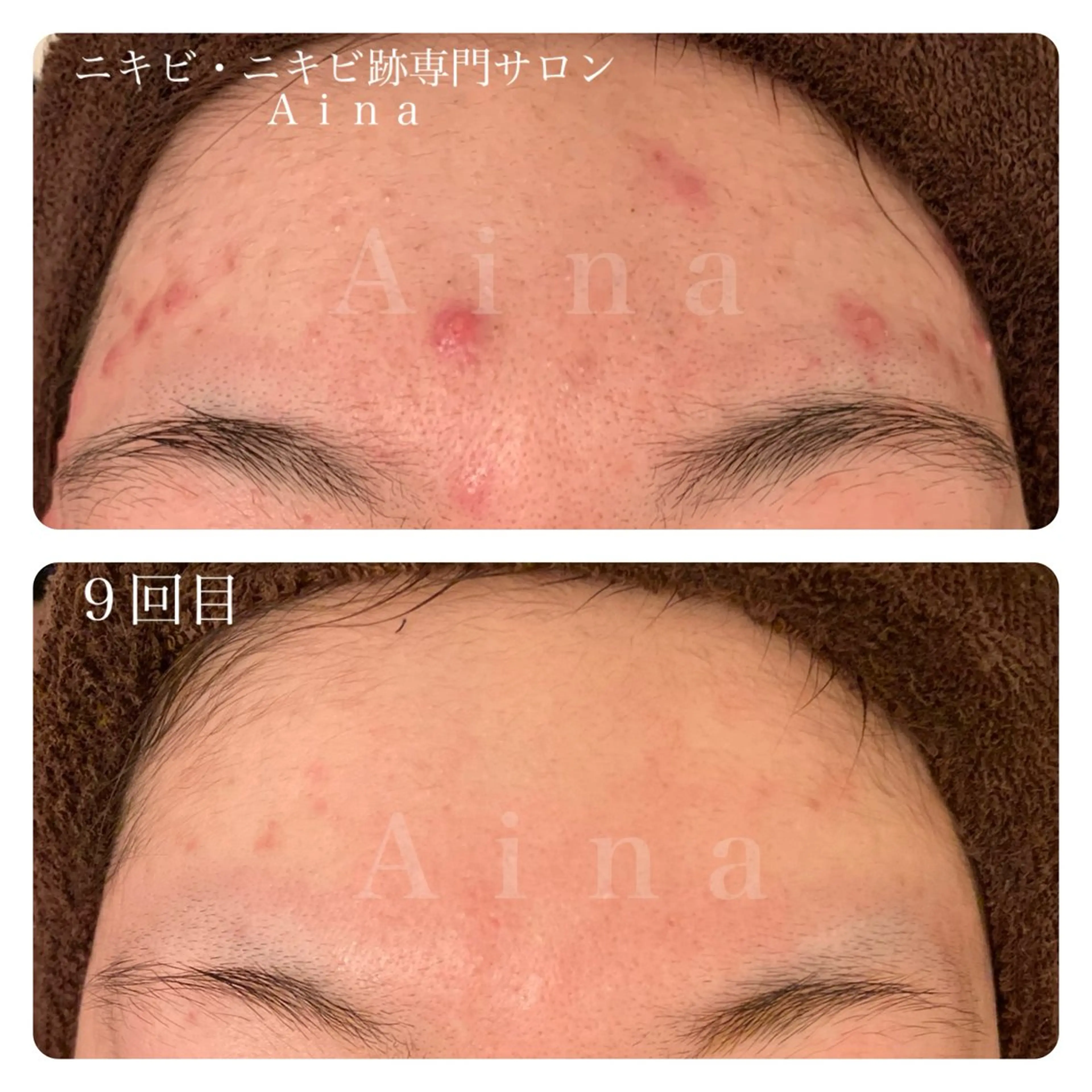 エステ リラク ニキビ跡専門サロン Ainaのエステ・リラクイメージ