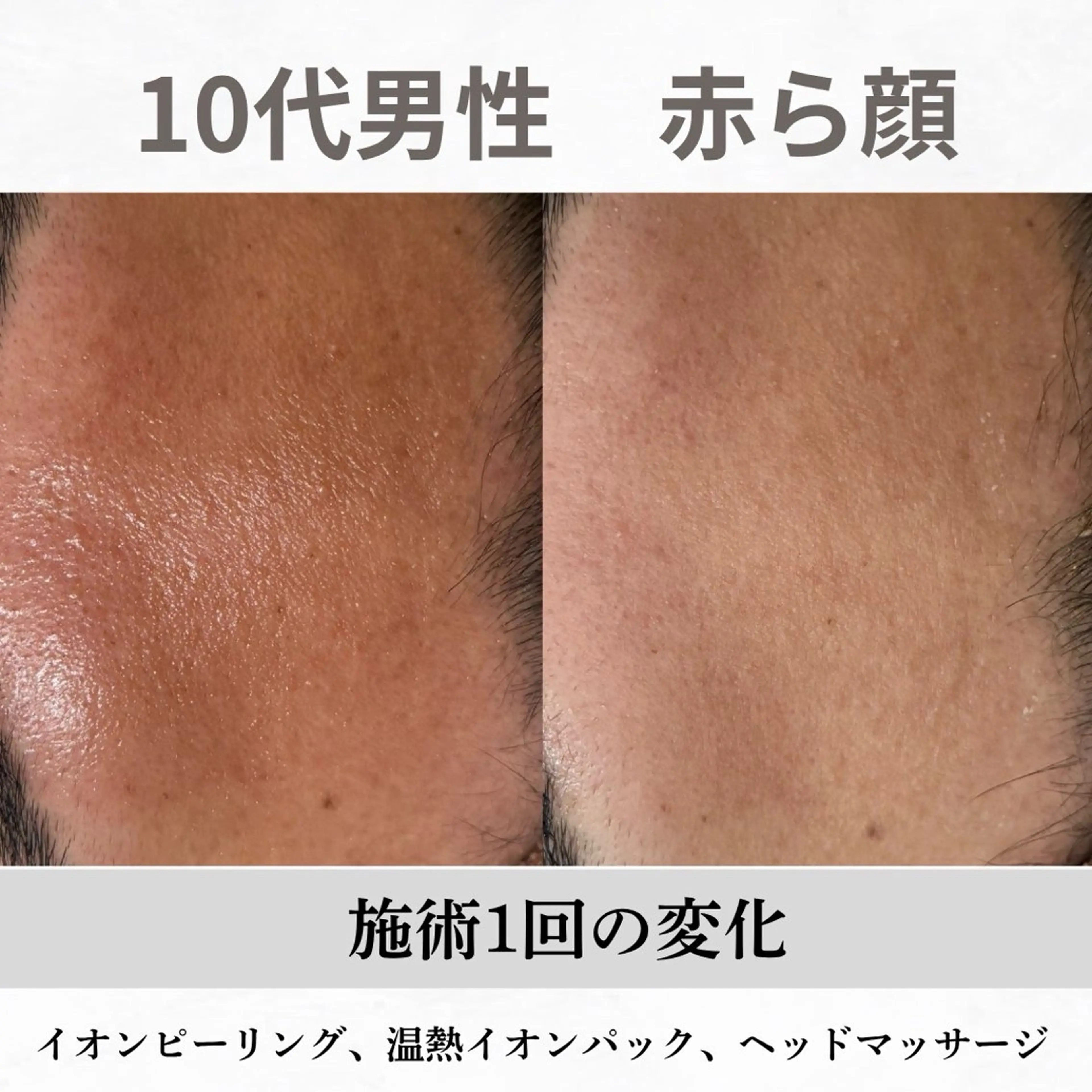 重度ニキビ専門🌷 ダウンタイムなしのエステ・リラクイメージ