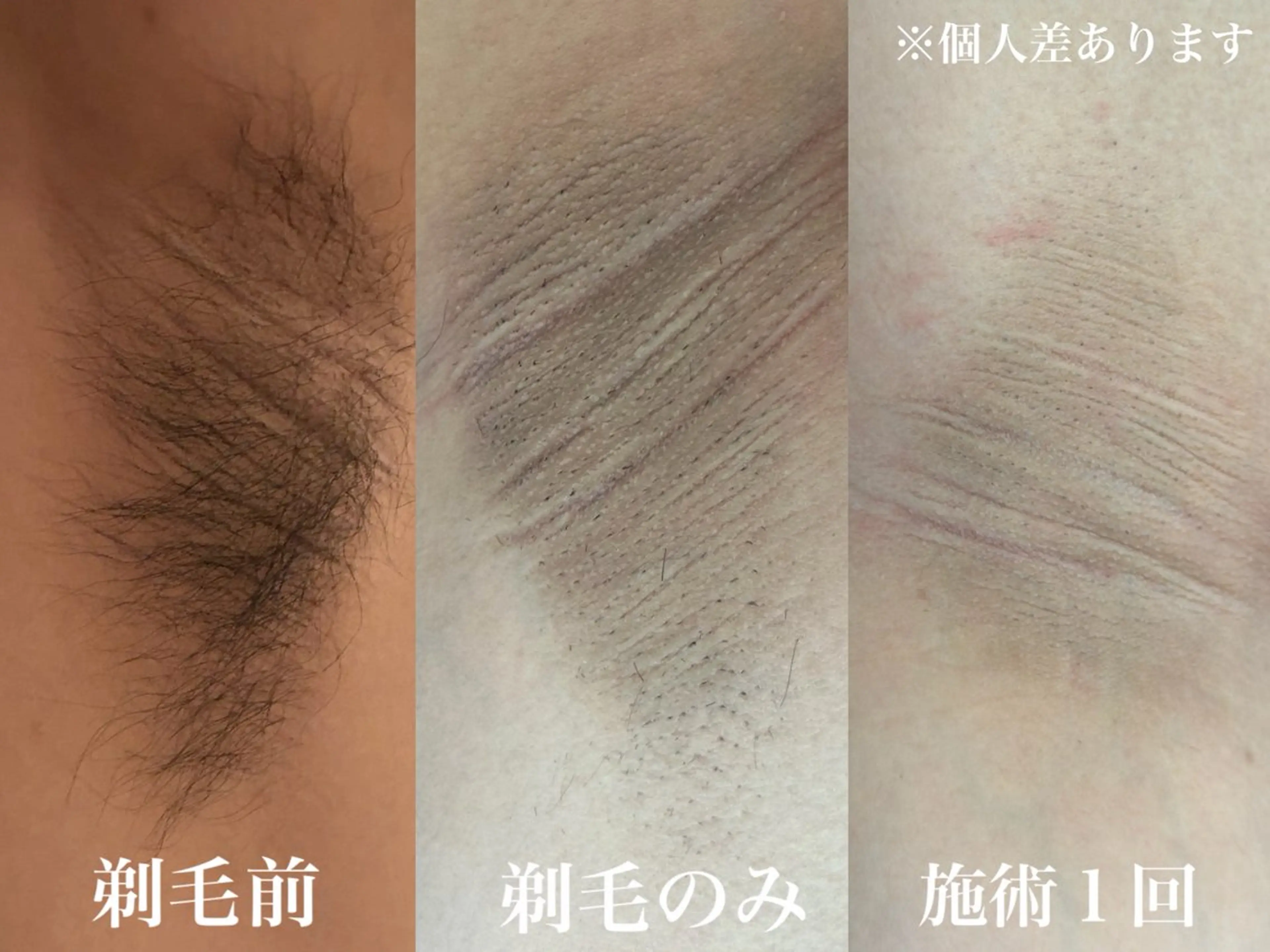 メンズ 脱毛 muumo まりののエステ・リラクイメージ