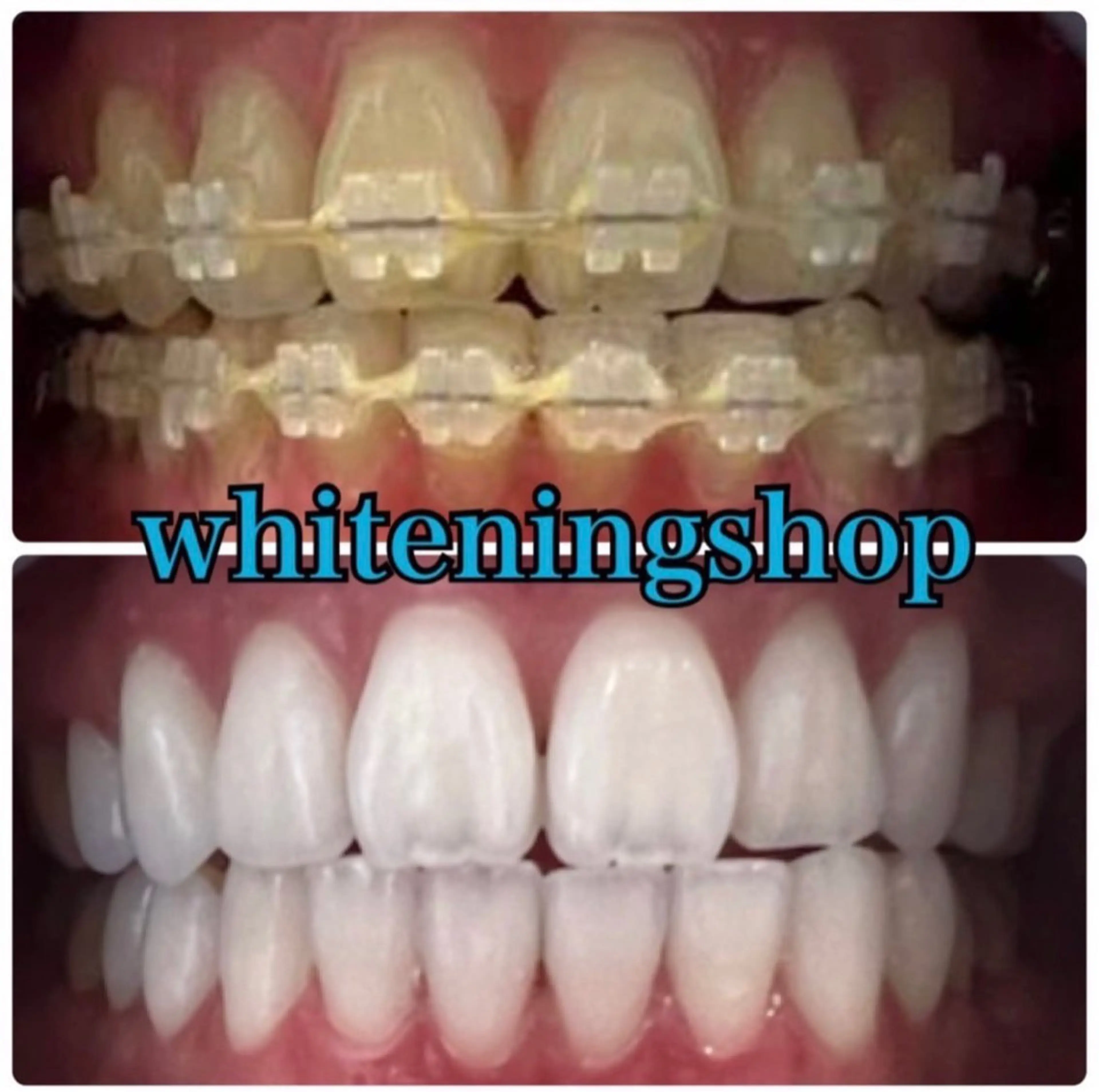 【6回コース】セルフホワイトニング20分照射×6回（20分照射一回あたり2200円でお得❤︎）の写真