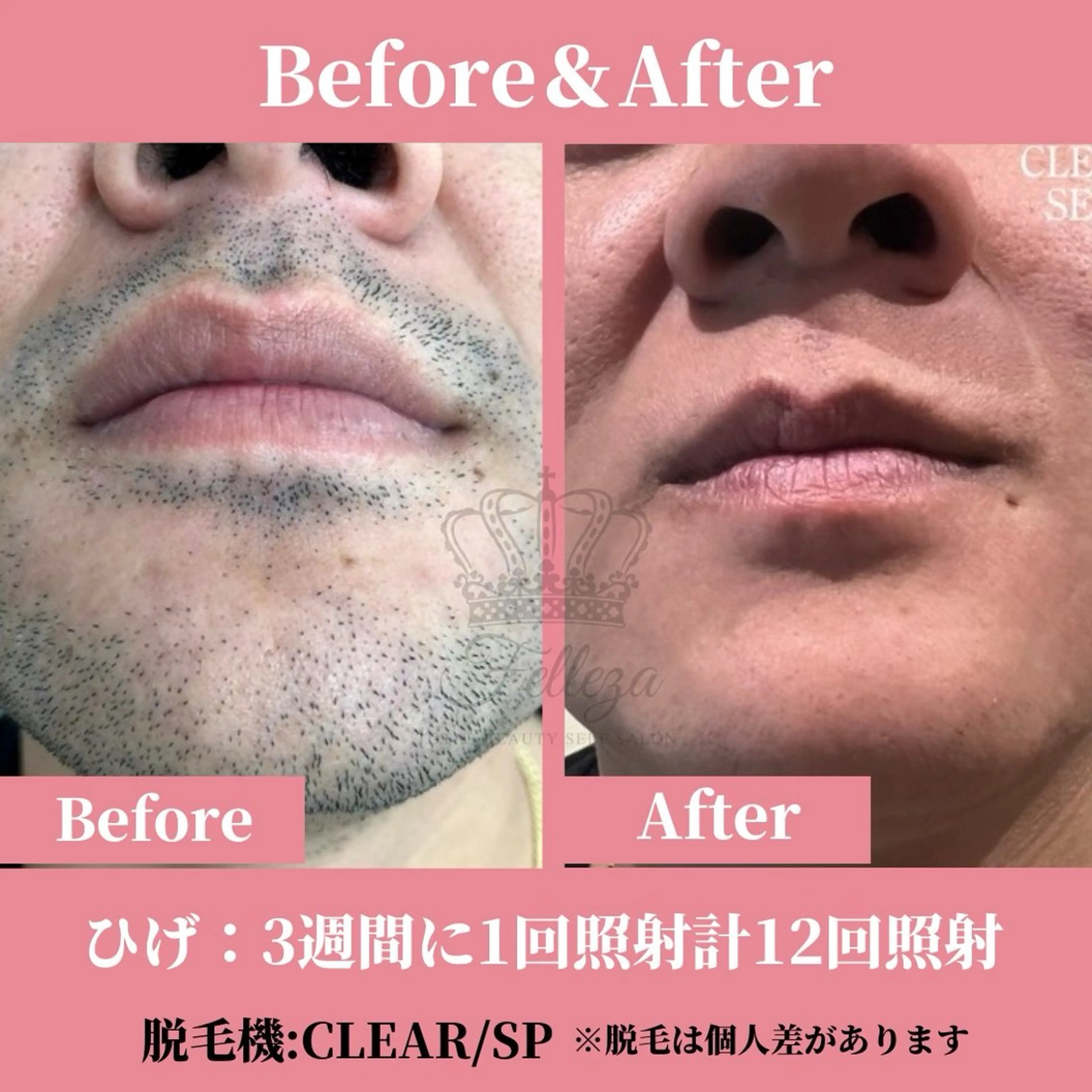 メンズ 有人型セルフサロン 脱毛／痩身／美顔のエステ・リラクイメージ