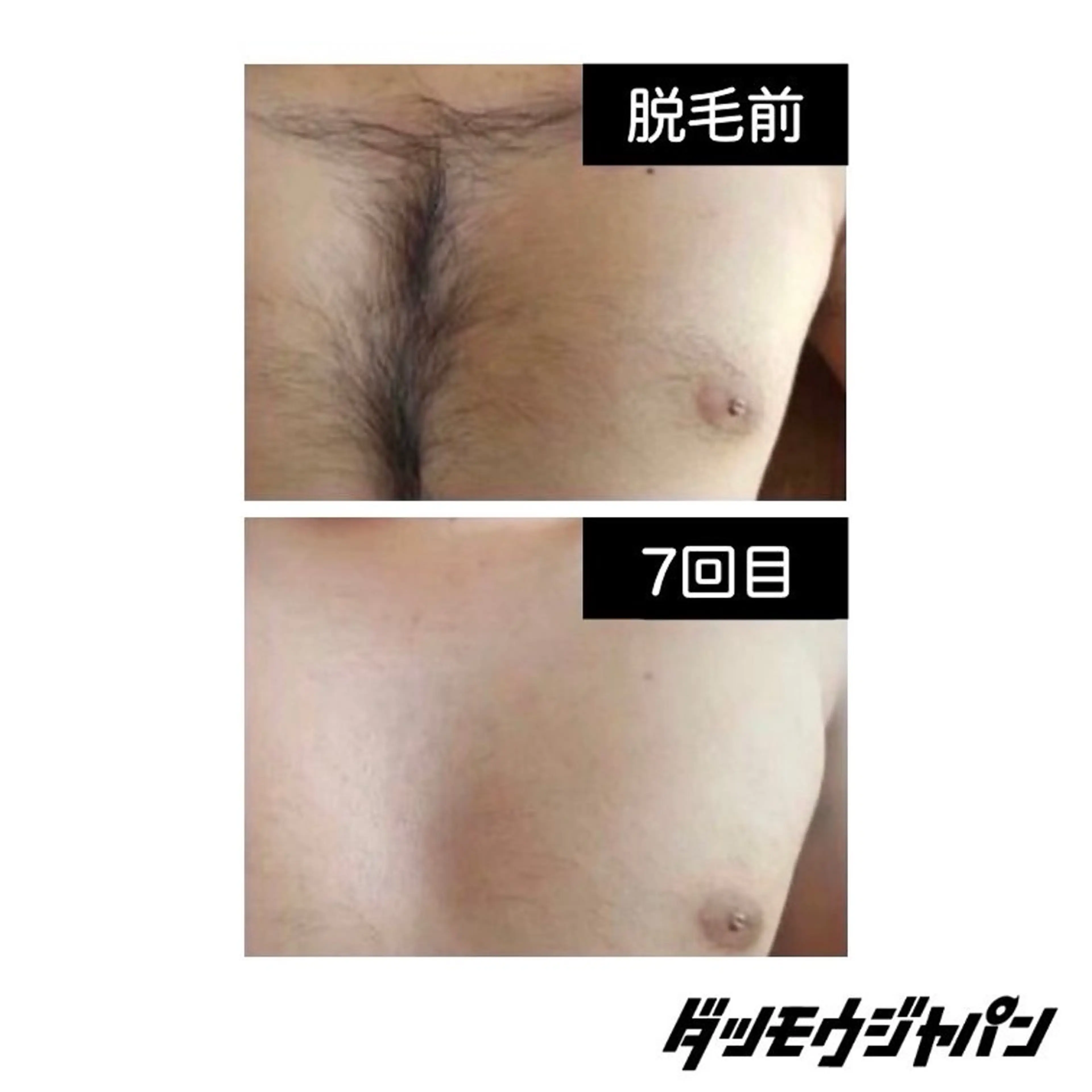 上半身脱毛(胸元全体)の写真