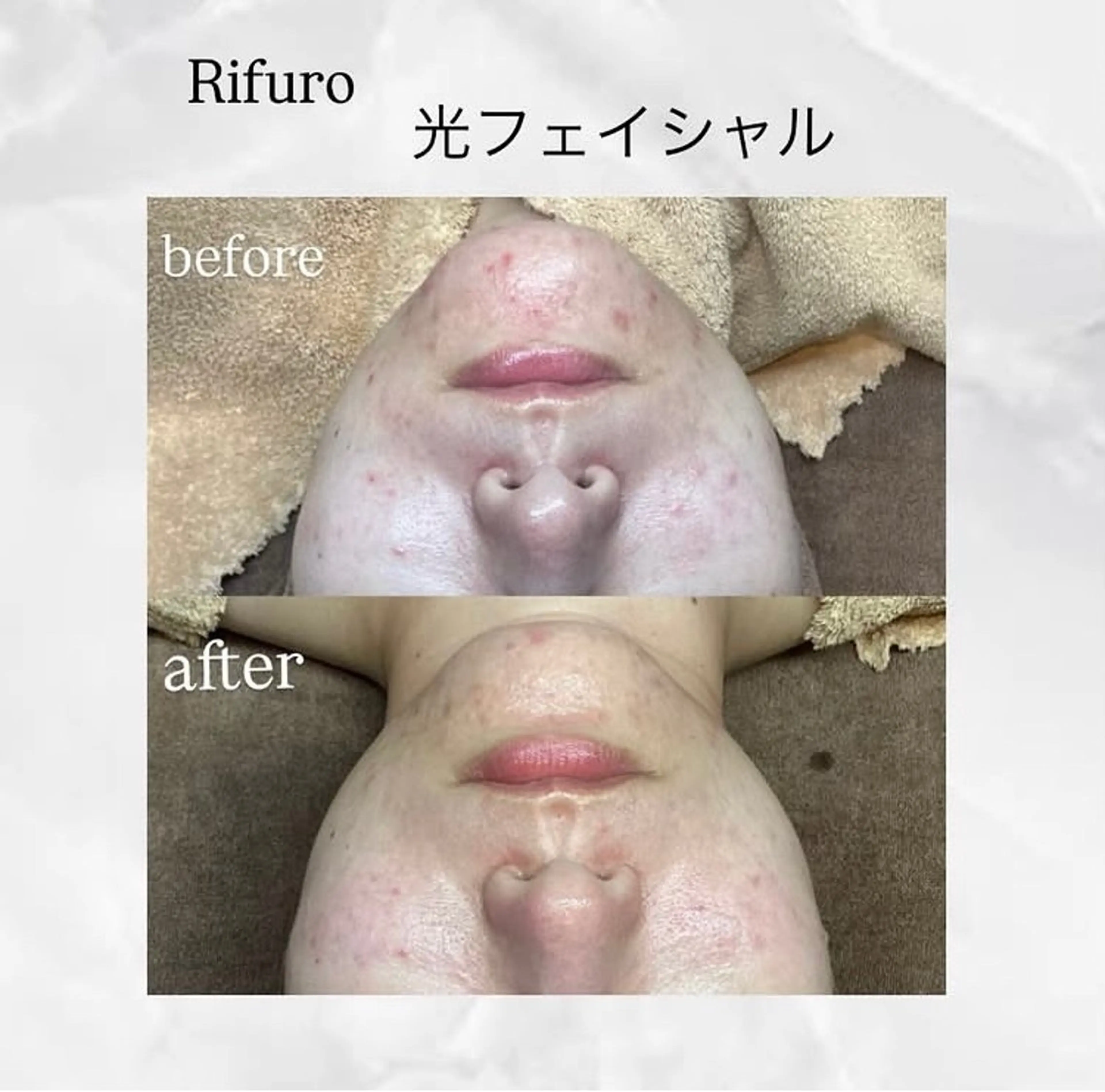 Rifuro 勝田台エステ所属・Rifuro勝田台 ララピール・毛穴洗浄のエステ・リラクイメージ