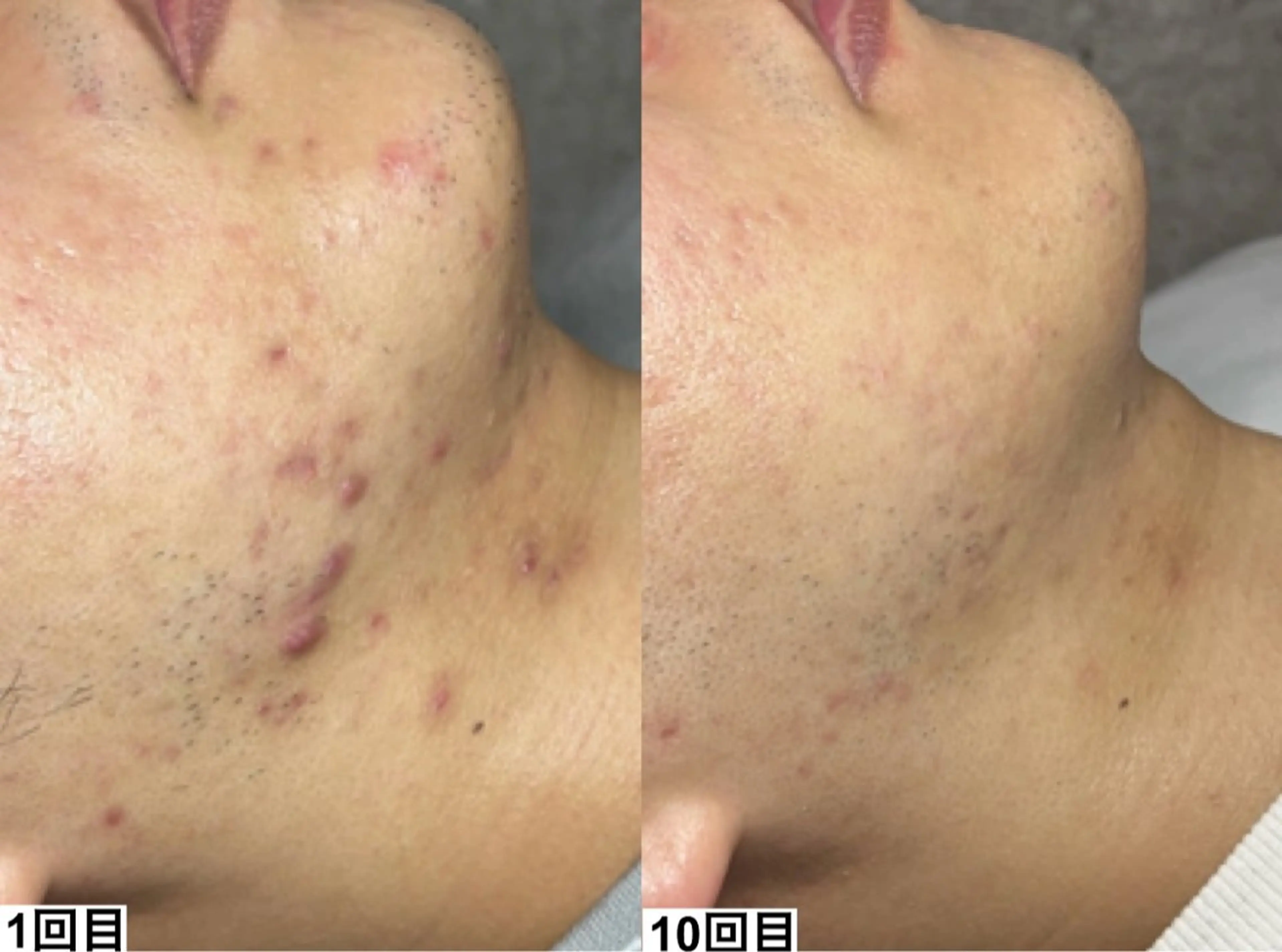 ピーリング×肌質管理 &meのエステ・リラクイメージ