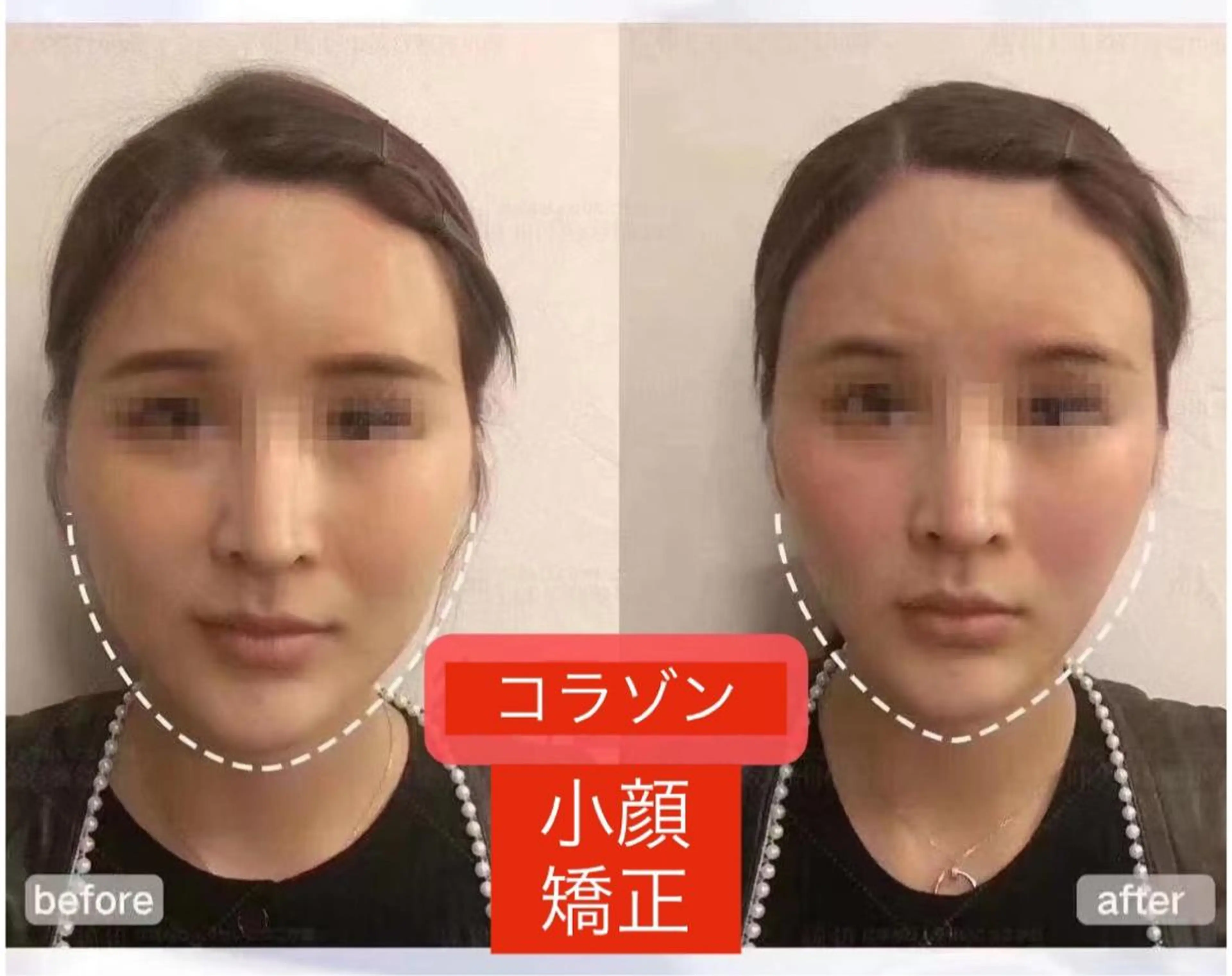 頭蓋骨小顔矯正の写真