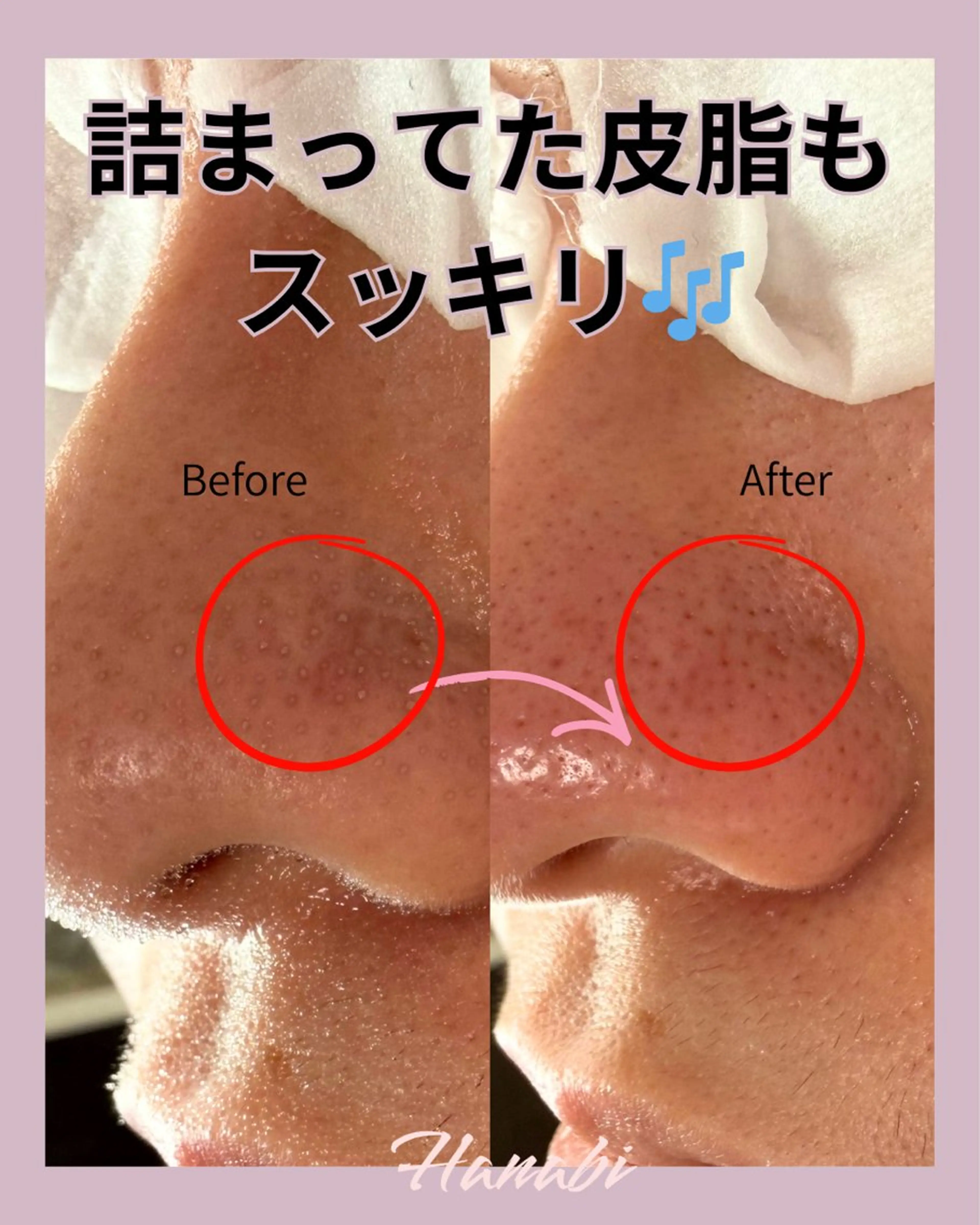 ✨大人気❣️✨【毛穴・黒ずみ・皮脂詰まり解消】毛穴ケアで悩みを解消！一度でつるんと透明感ある肌へ導きます！の写真