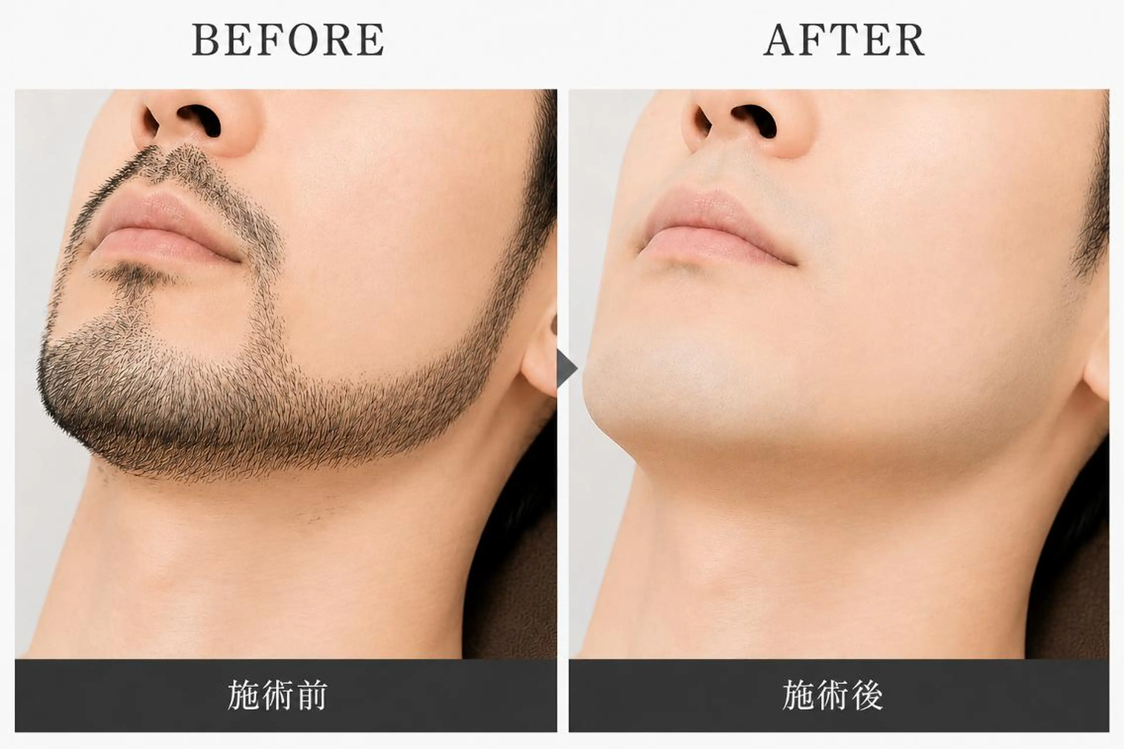 【レッスンモデル】メンズ限定髭WAX脱毛募集※5/26、5/27限定⚠️必ず詳細をご確認ください⚠️の写真