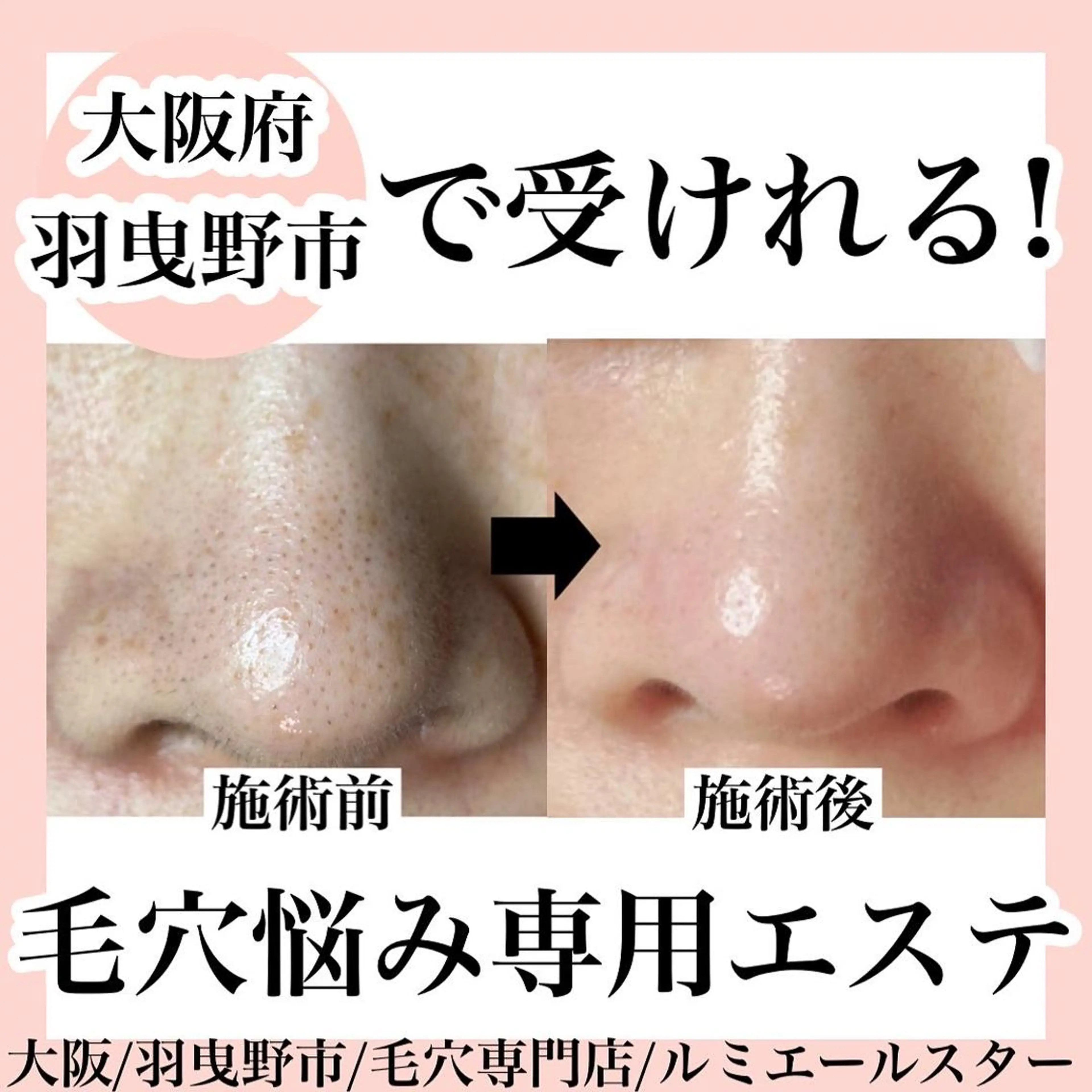 エステ 最速 毛穴シミ改善 いくえのその他イメージ