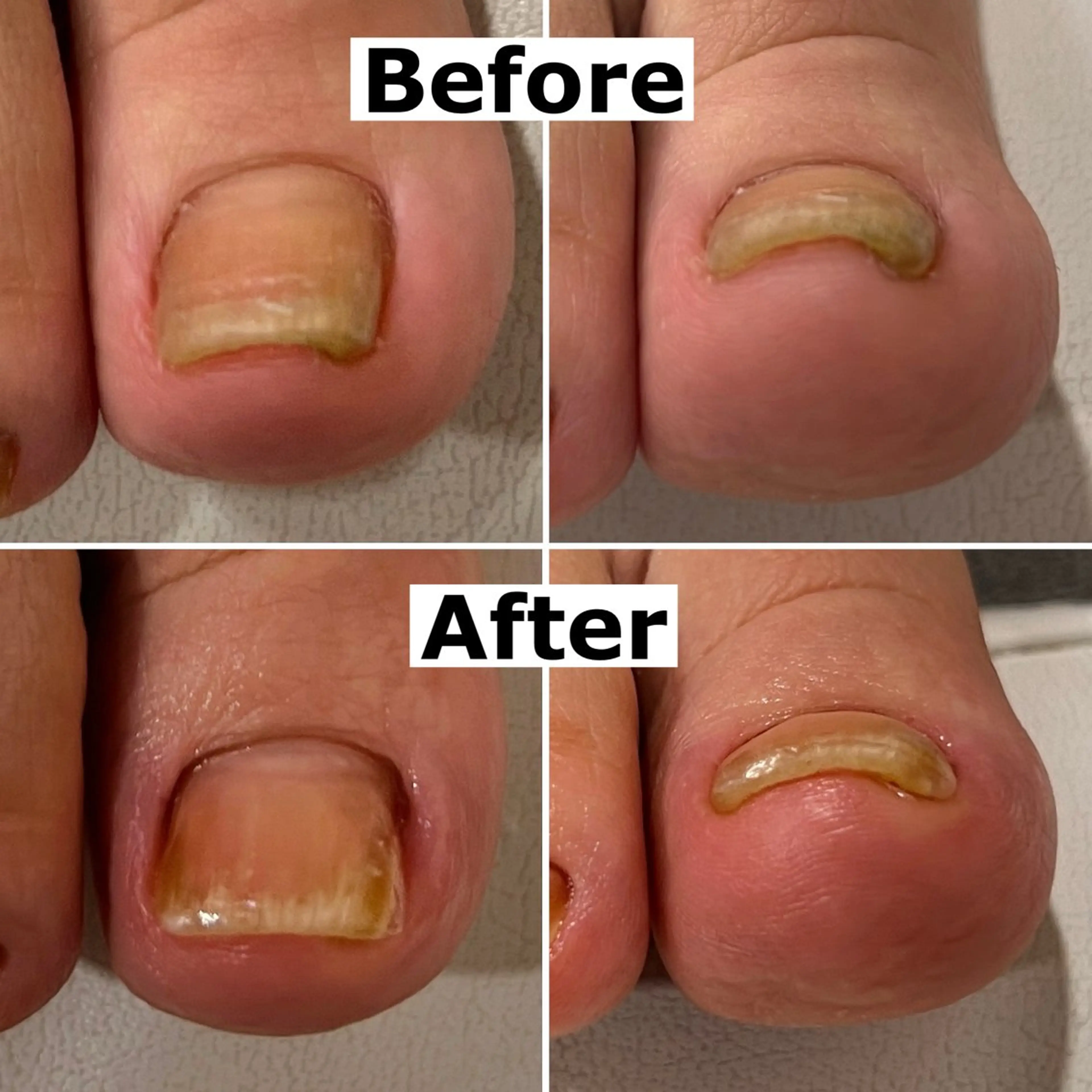 ネイル 巻爪無料モデル募集 ✨🦶MEGUMIのネイルデザイン