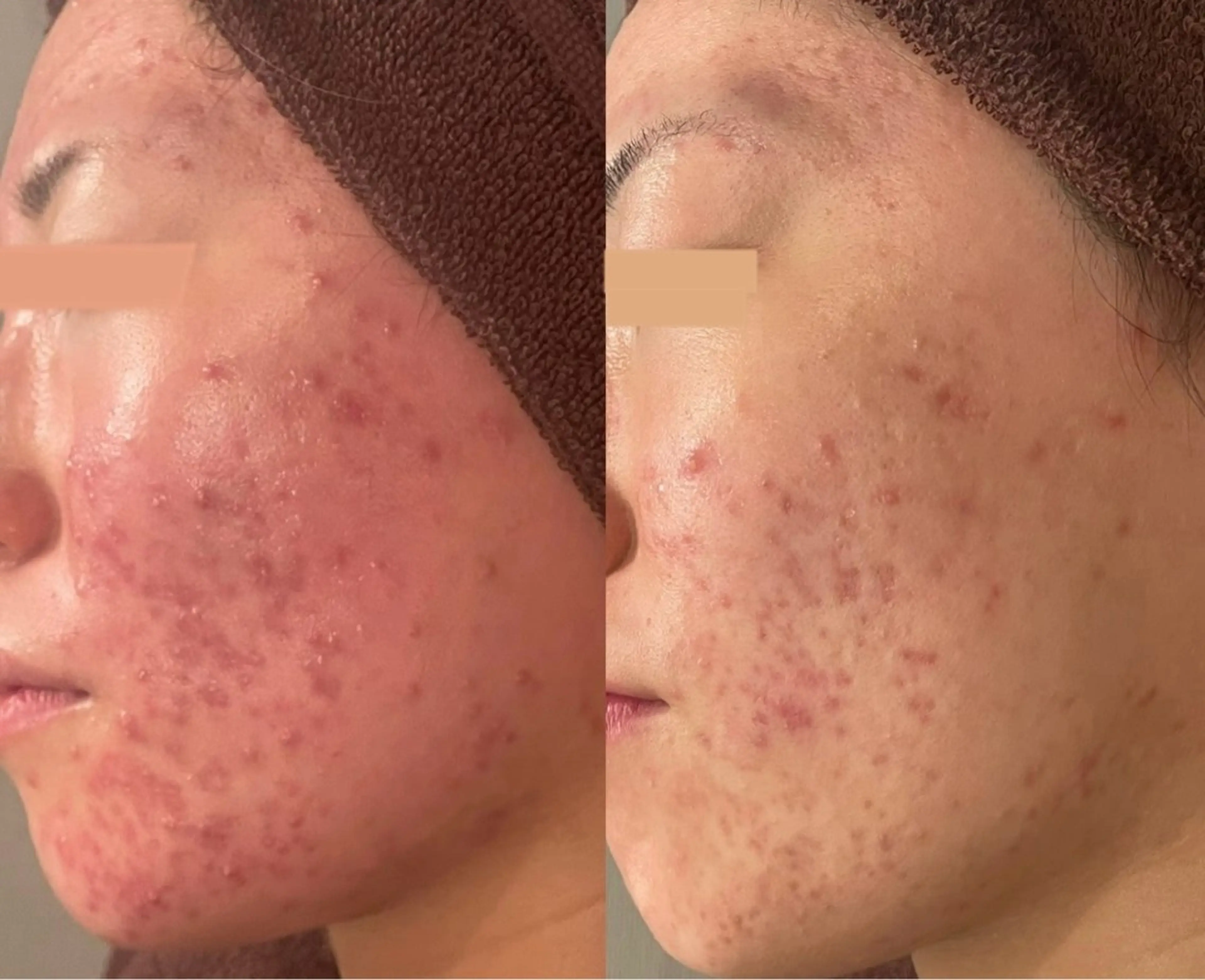 剥離なしハーブピーリング※剥離ありを希望の方はご相談くださいの写真