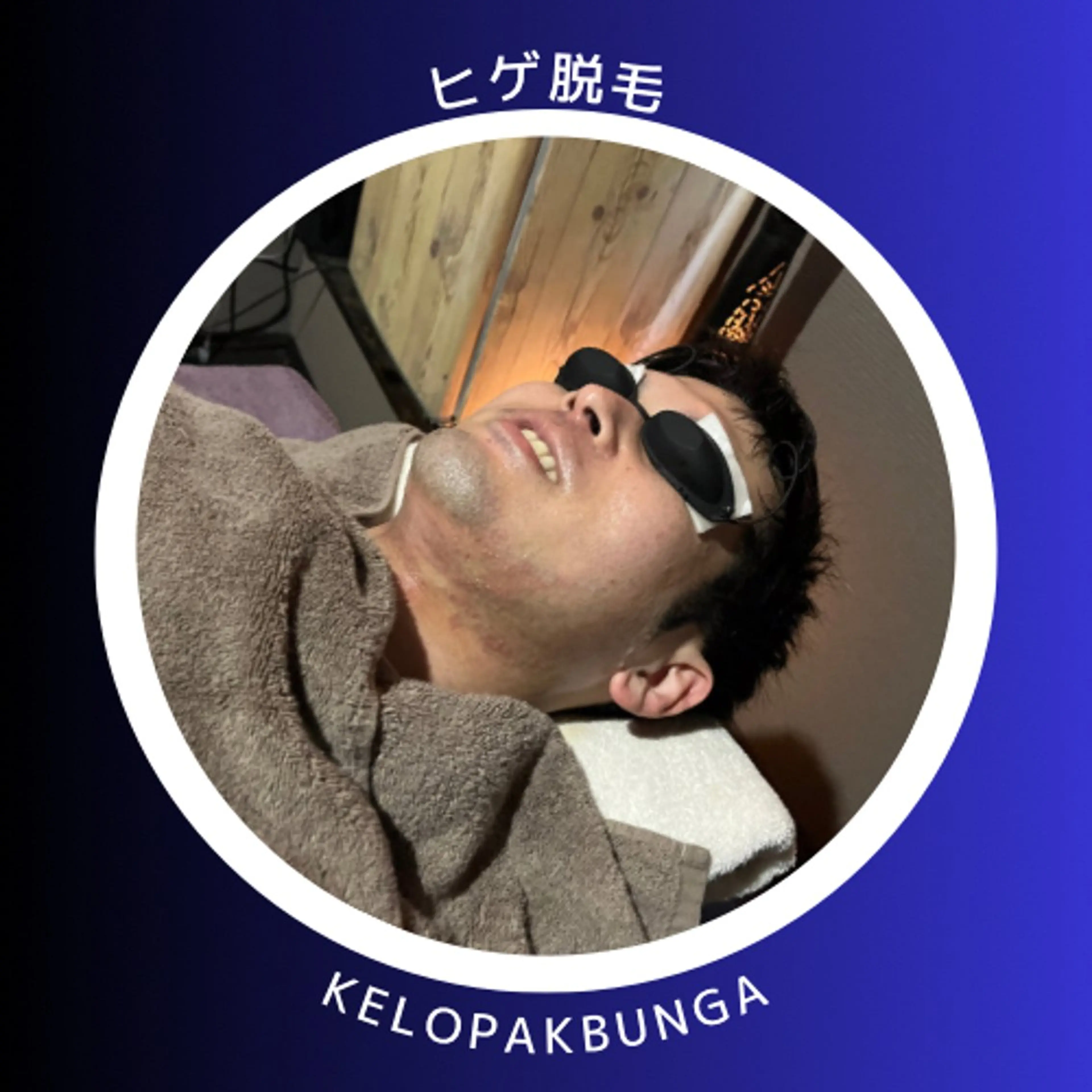 🩵メンズ🩵ヒゲ脱毛　(美容保湿パック付)の写真