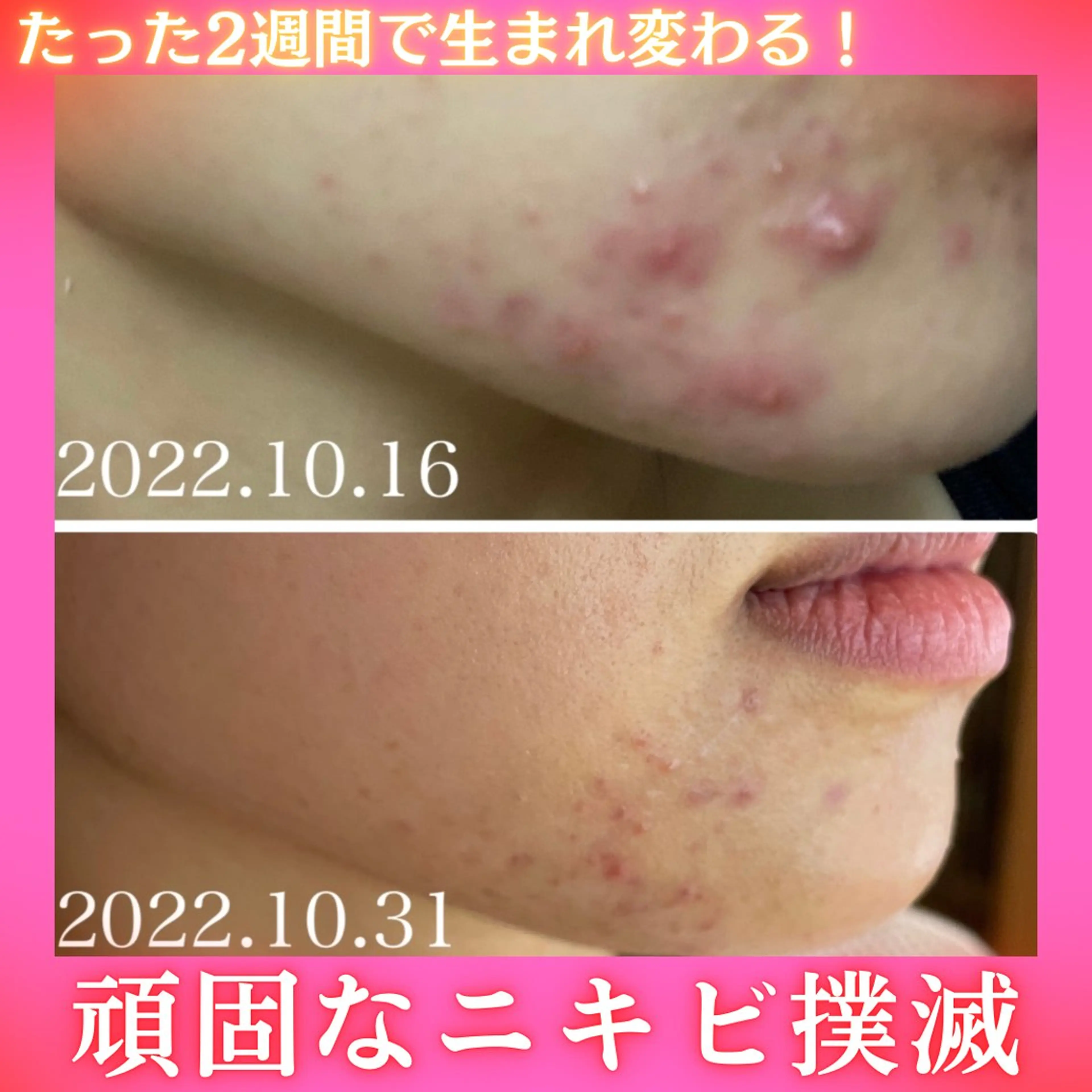 【HAAB】10回のエステより1回の🌱ハーブピーリング🌱本気で肌質を変えたい方.ᐟ ニキビ/シミ/クレーター/シワの写真