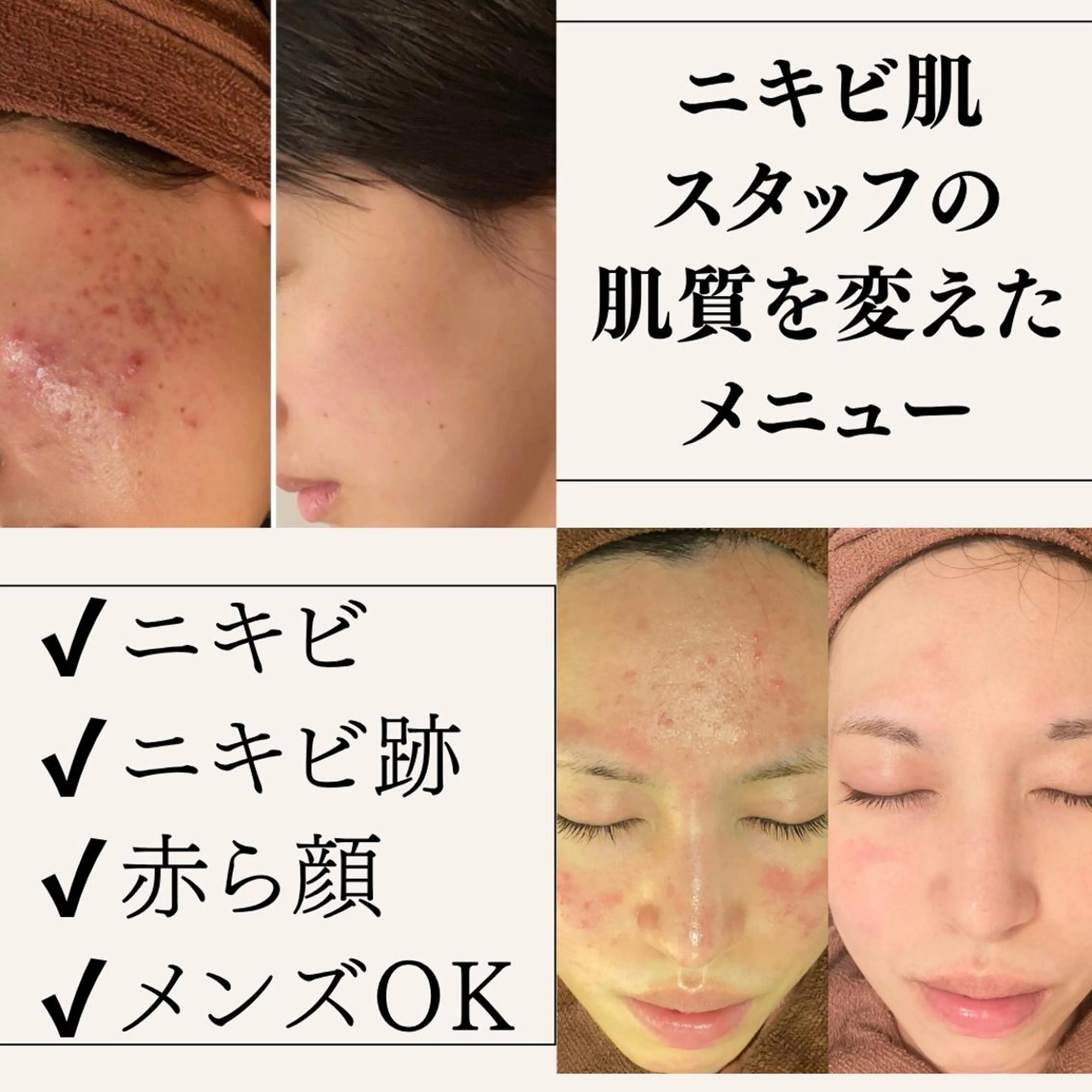 私の激荒れ肌はこれで改善した👀｜1日2組限定の当サロンオリジナル・ニキビ/ニキビ跡ケアコース👼✨の写真