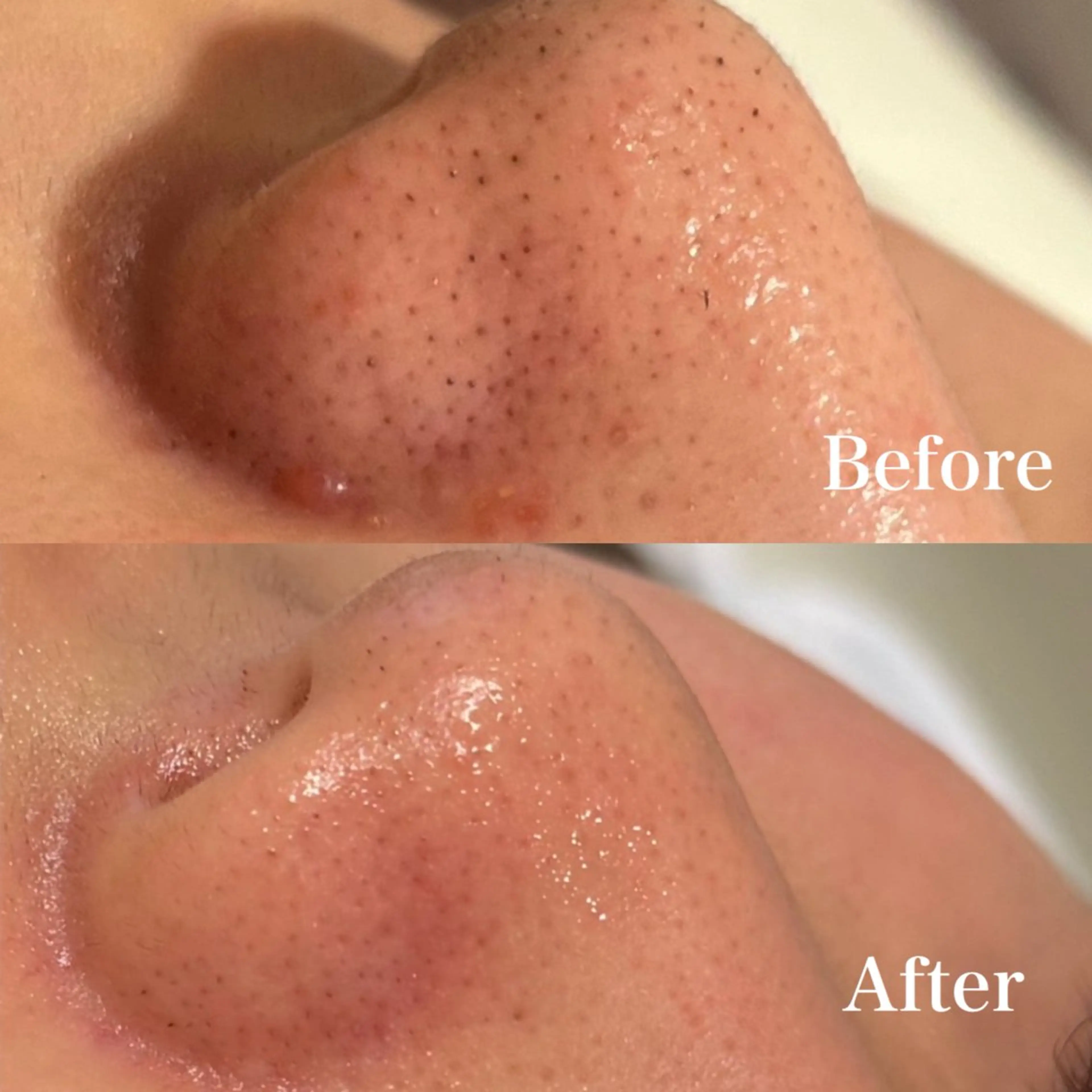 【モデル価格10名限定】🫧全顔毛穴洗浄🫧|水光肌ケア|ハイドラフェイシャル ⚠️動画撮影・口コミ可能な方のみの写真