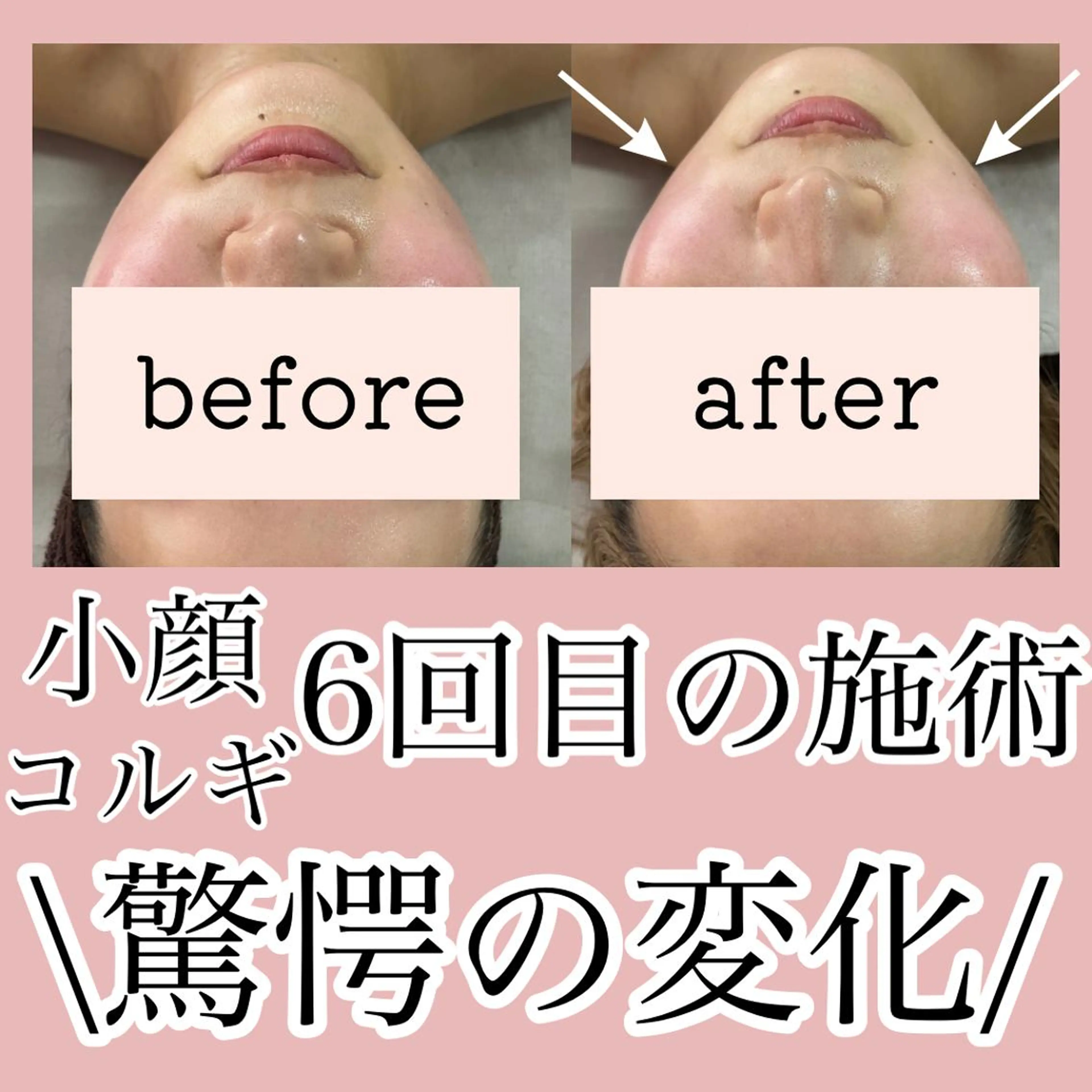 顔コルギ＋カッサ💆 【顔のむくみ】【たるみ】【ほうれい線】などのお悩みに✨超絶小顔‼️の写真