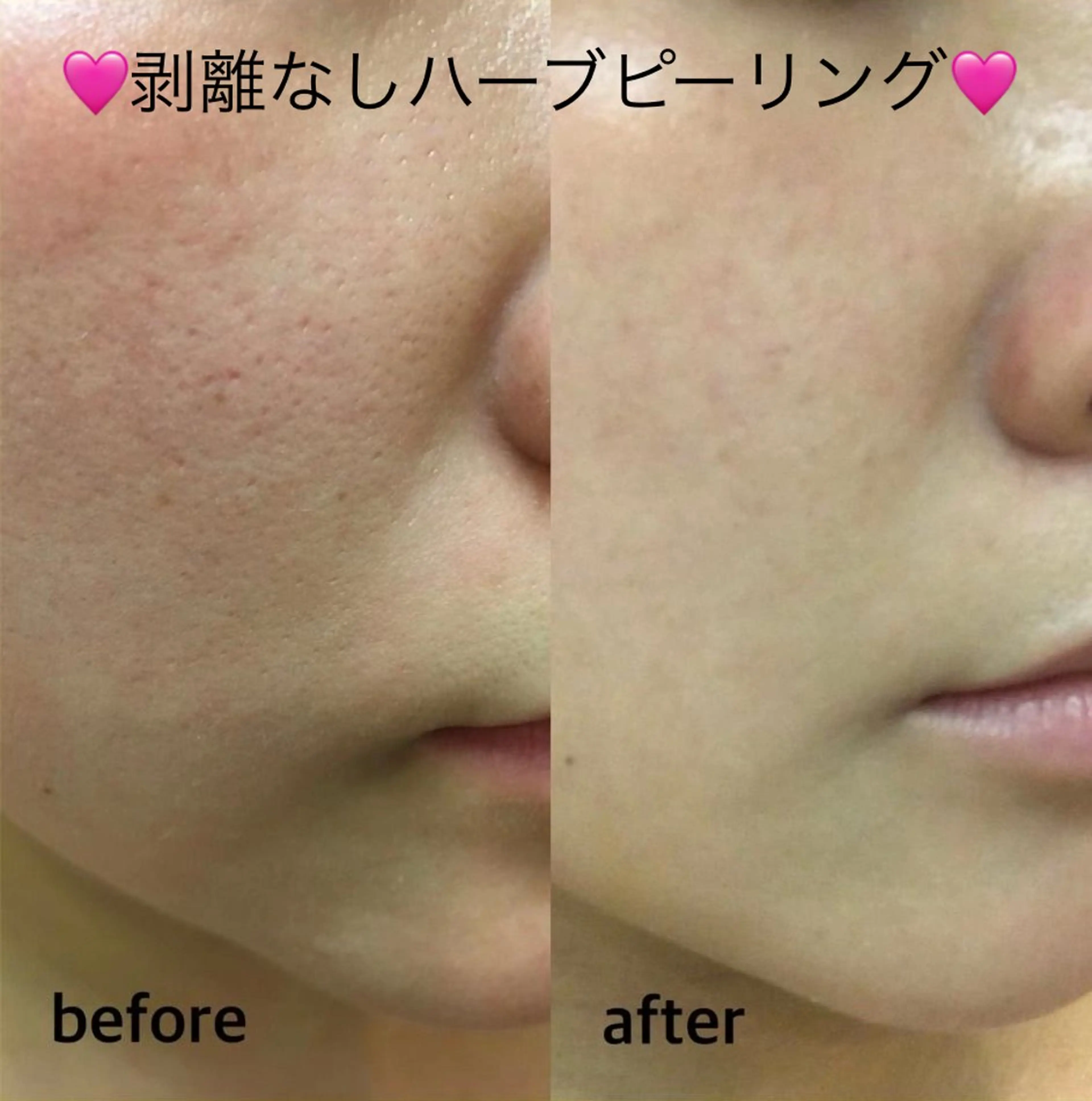 エステ ハーブピーリング専門 毛穴洗浄❤️眉waxのエステ・リラクイメージ