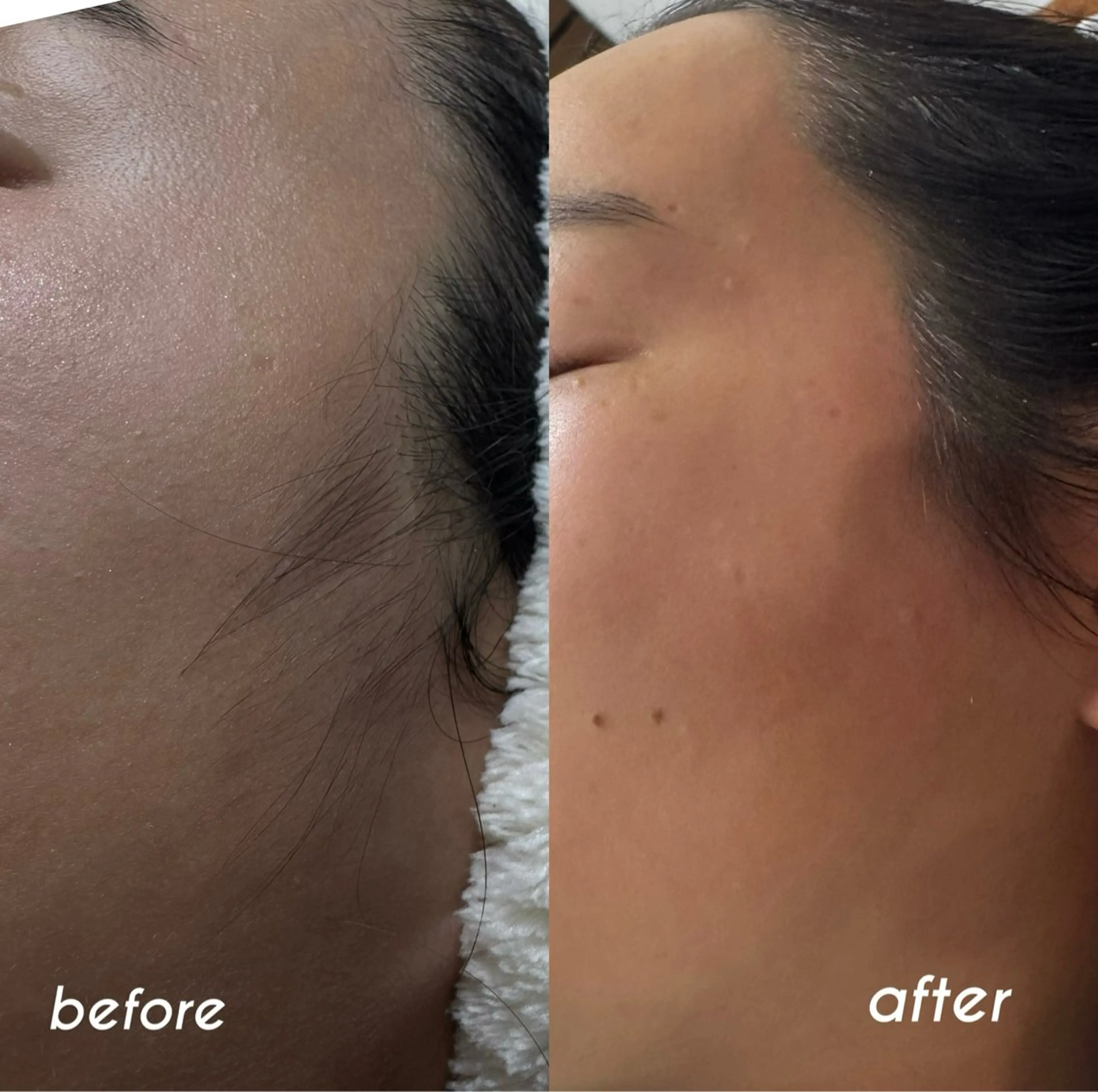 【初回限定】フェイシャルワックス〈顔のみ〉45分｜¥7,000の写真