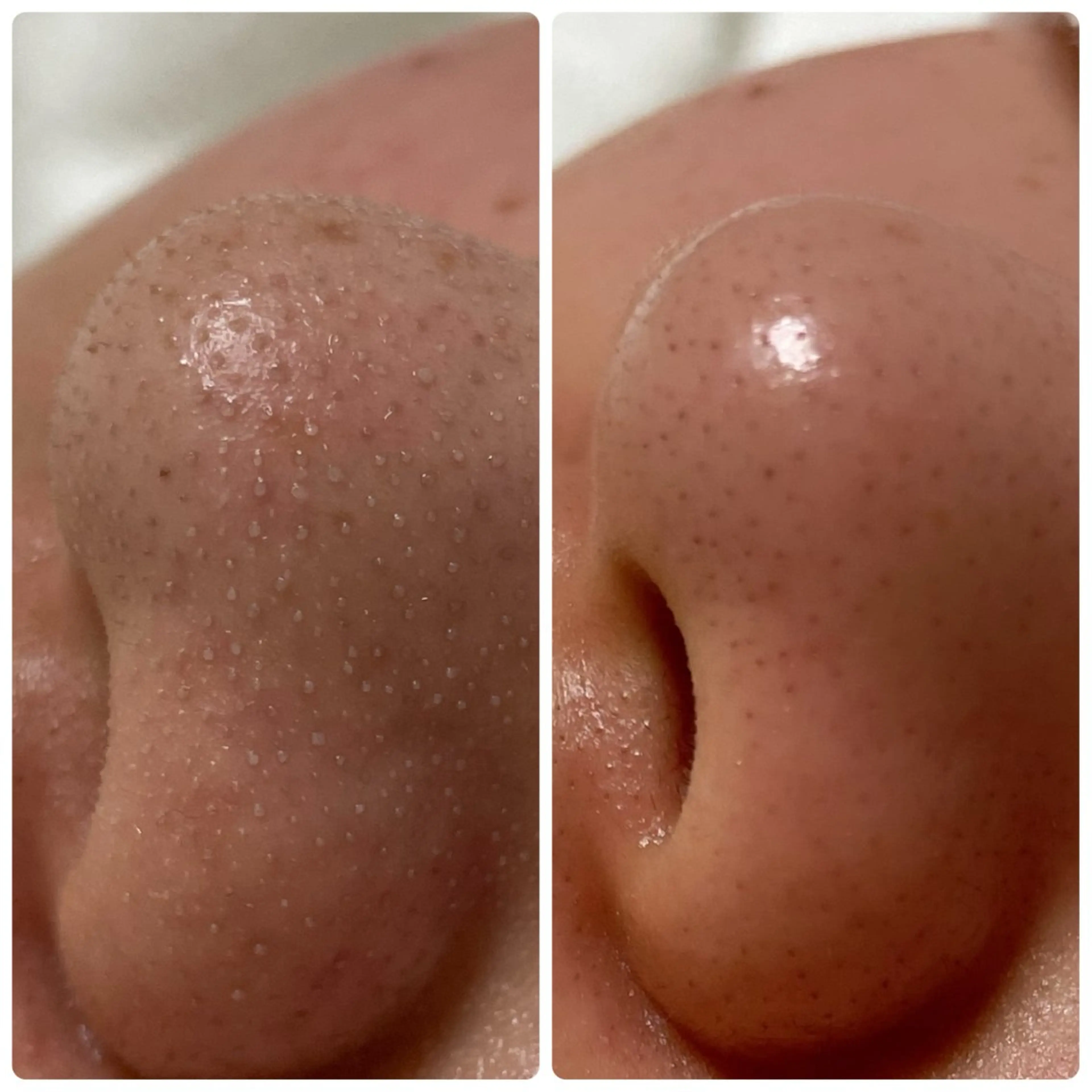 とことん毛穴洗浄！とリラックスエステの写真