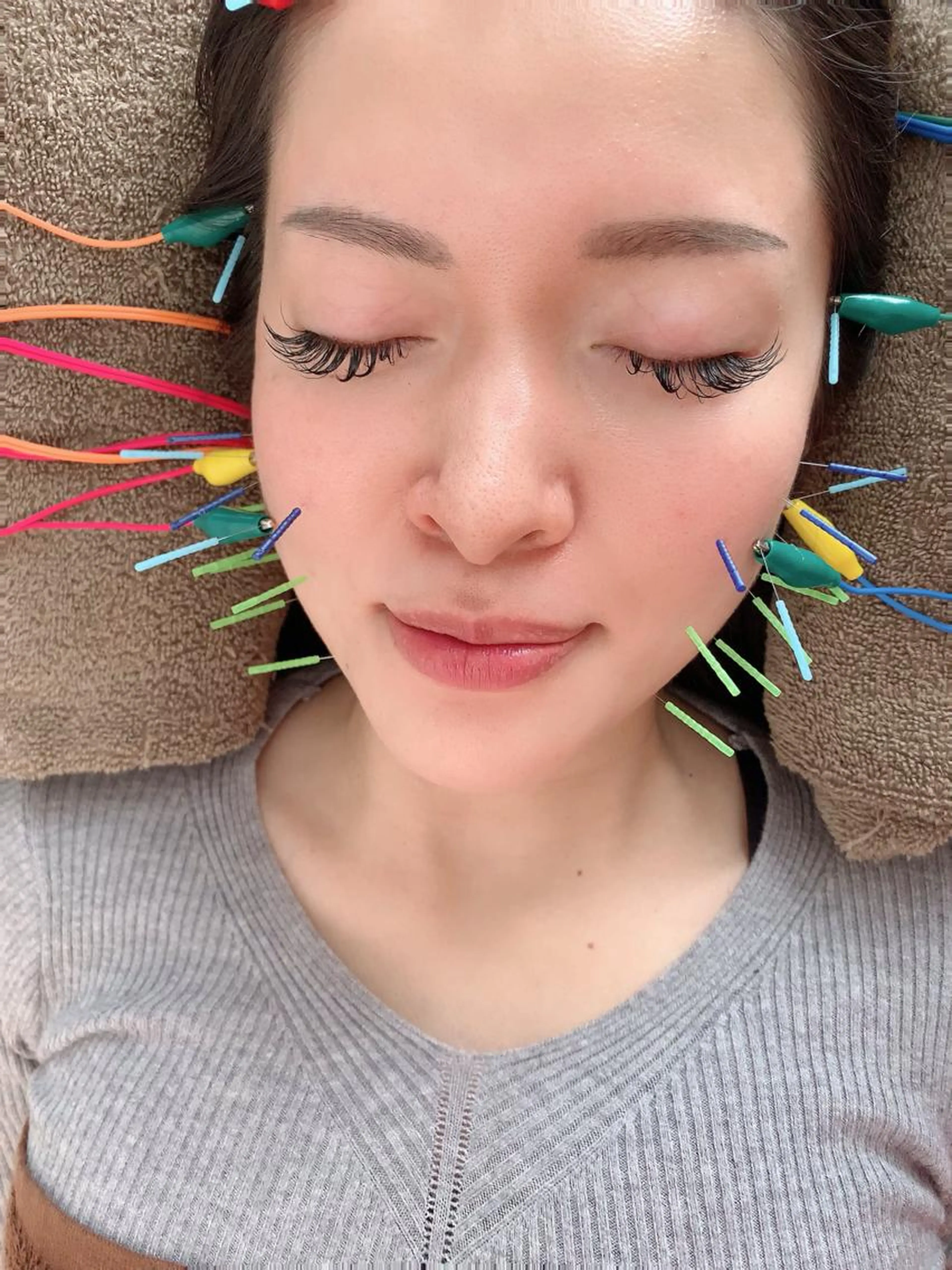 ✨肌荒れにイチオシ美容鍼✨（電気鍼＋首のマッサージ）吹き出物などにも効果的！の写真