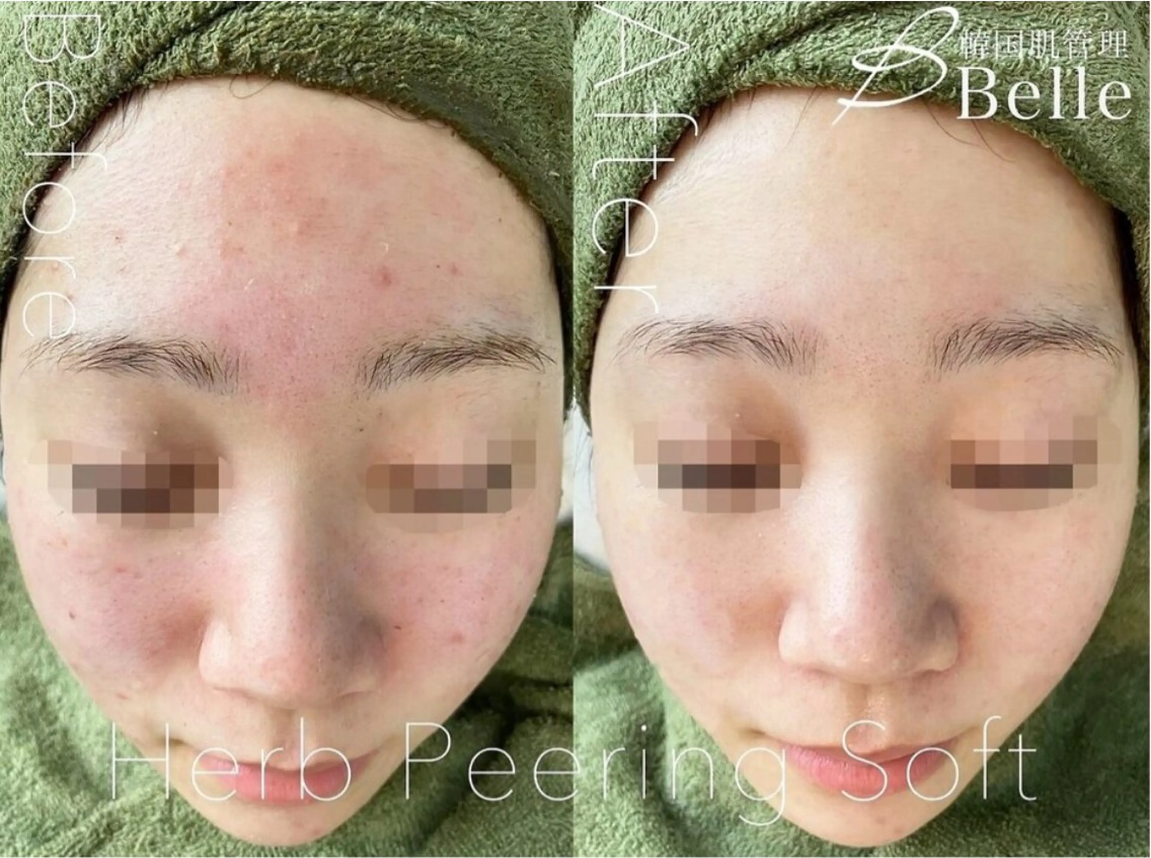 Belle目黒 /ハーブピーリングのエステ・リラクイメージ