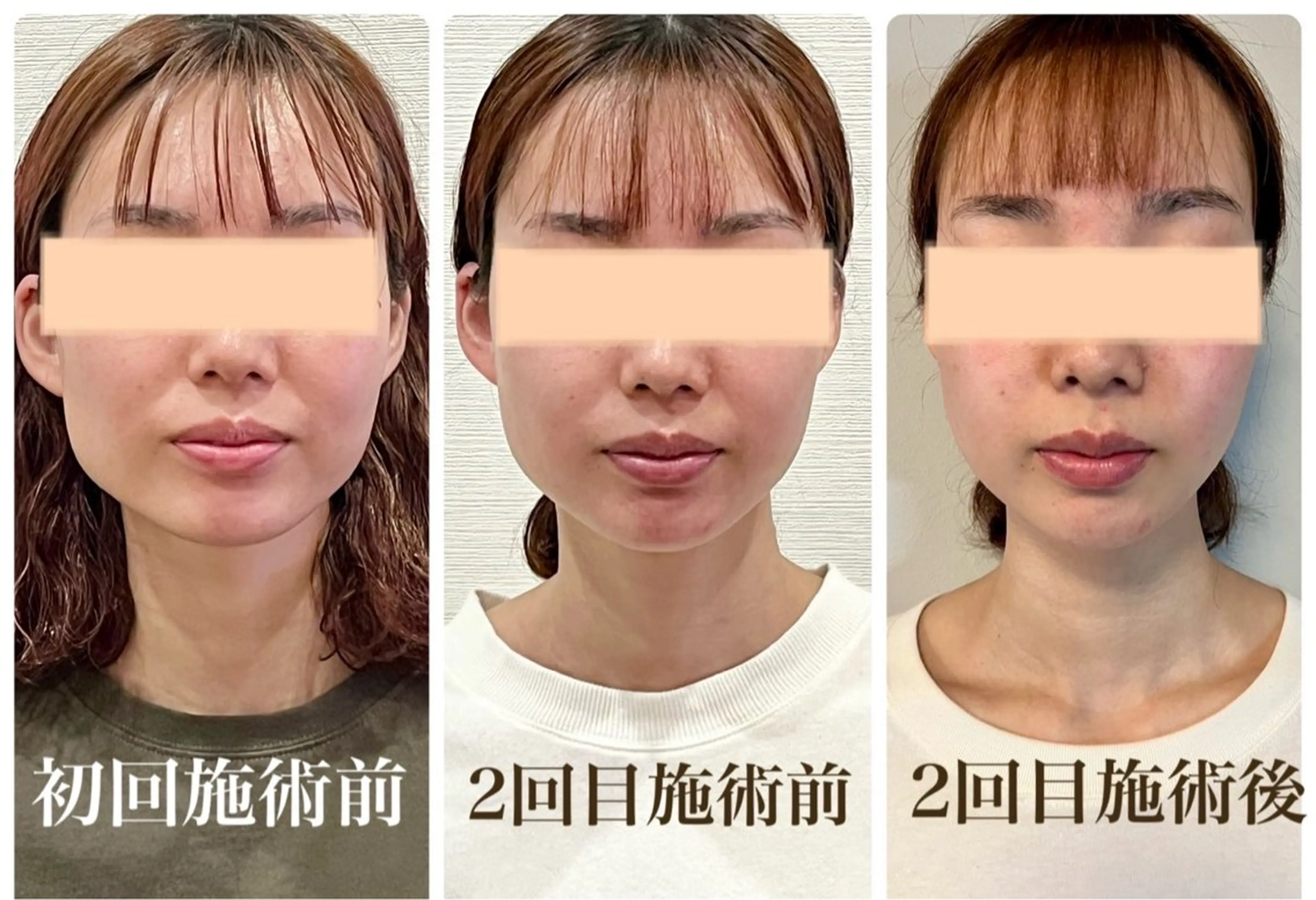 小顔矯正の写真