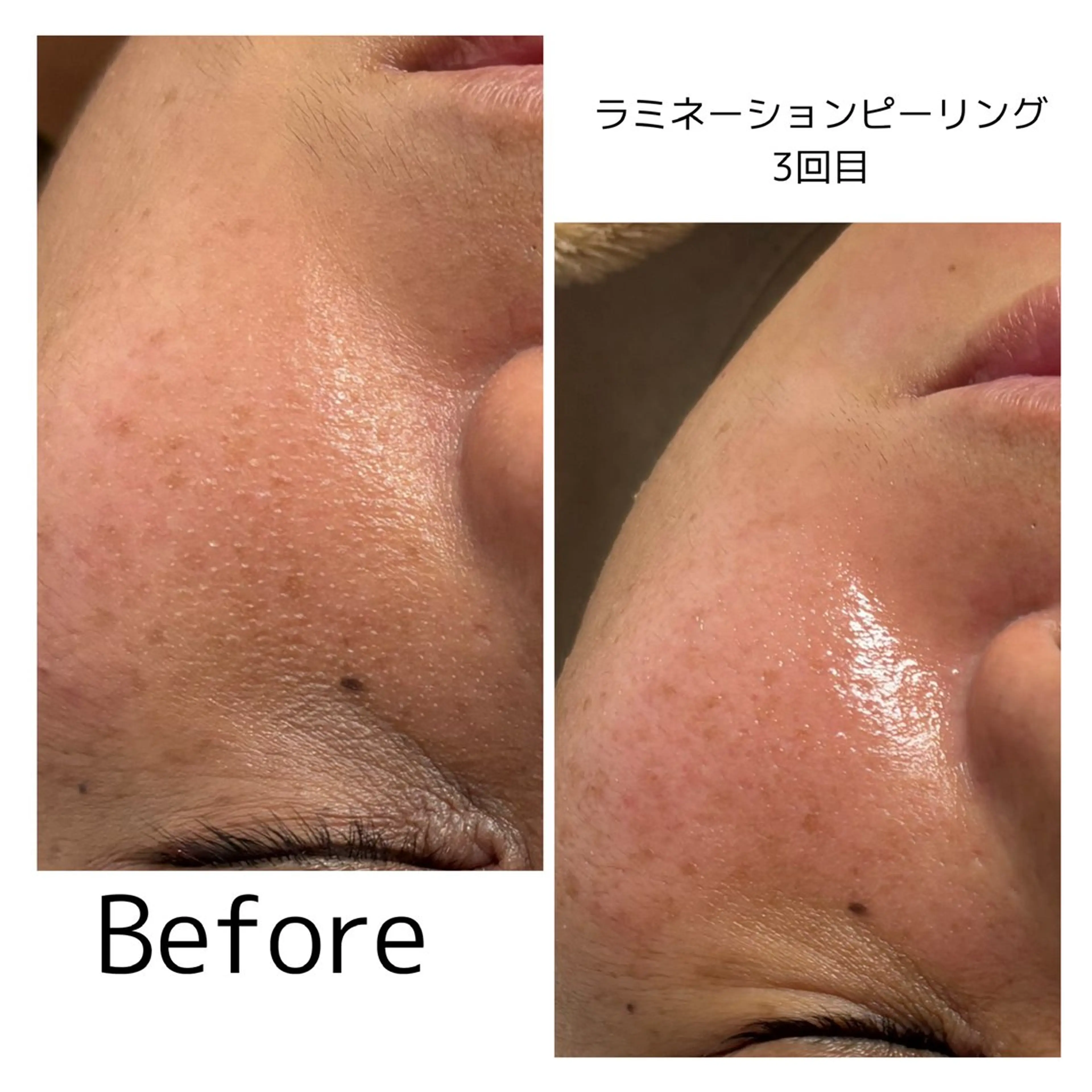 【美肌🌿ラミネーションピーリング】剥離なし・低刺激✨内から輝く水光肌へ。くすみをオフして、潤いと弾力に満ちたツヤ肌体験の写真