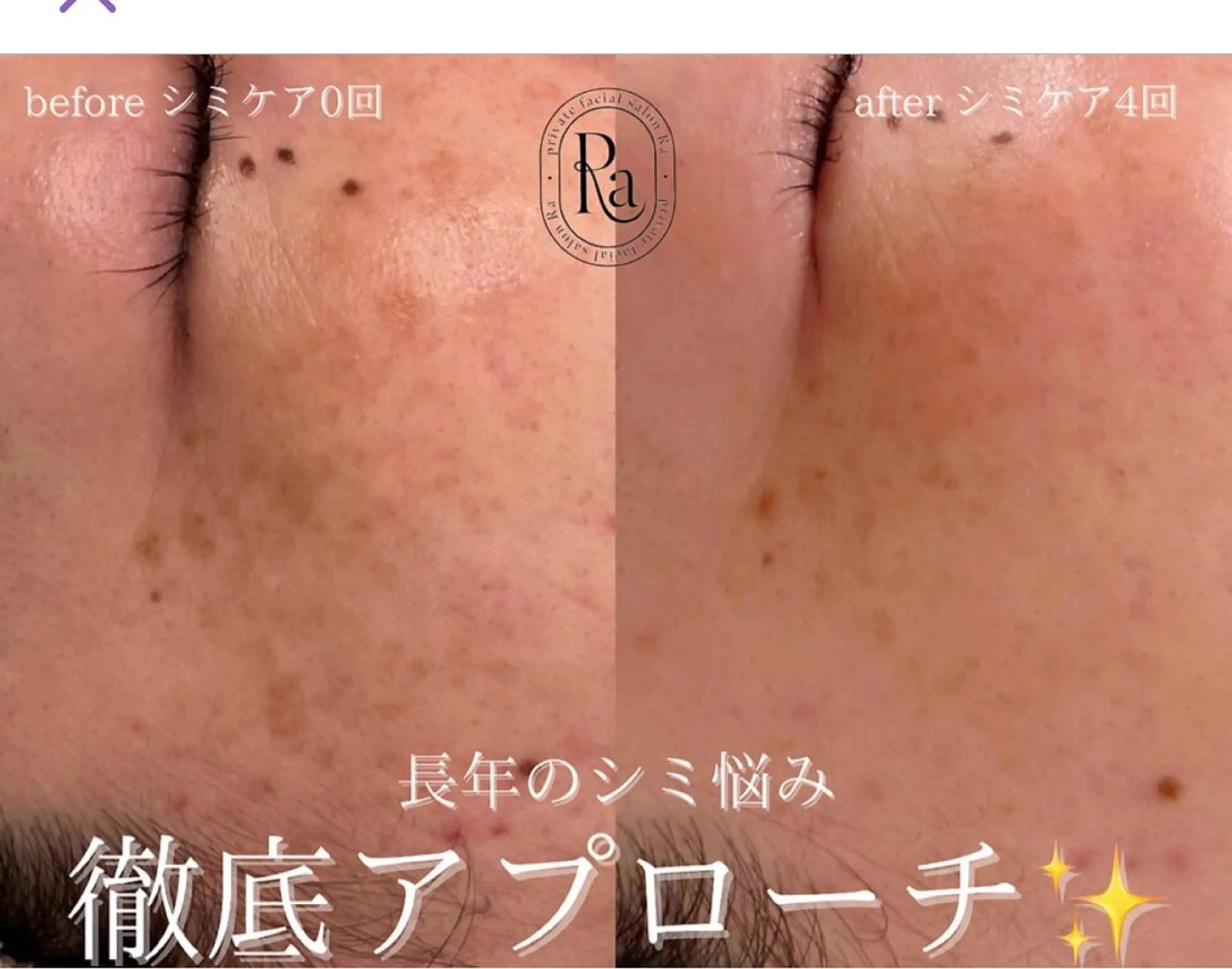 【シミ管理】30分シミ取り放題(全顔)の写真