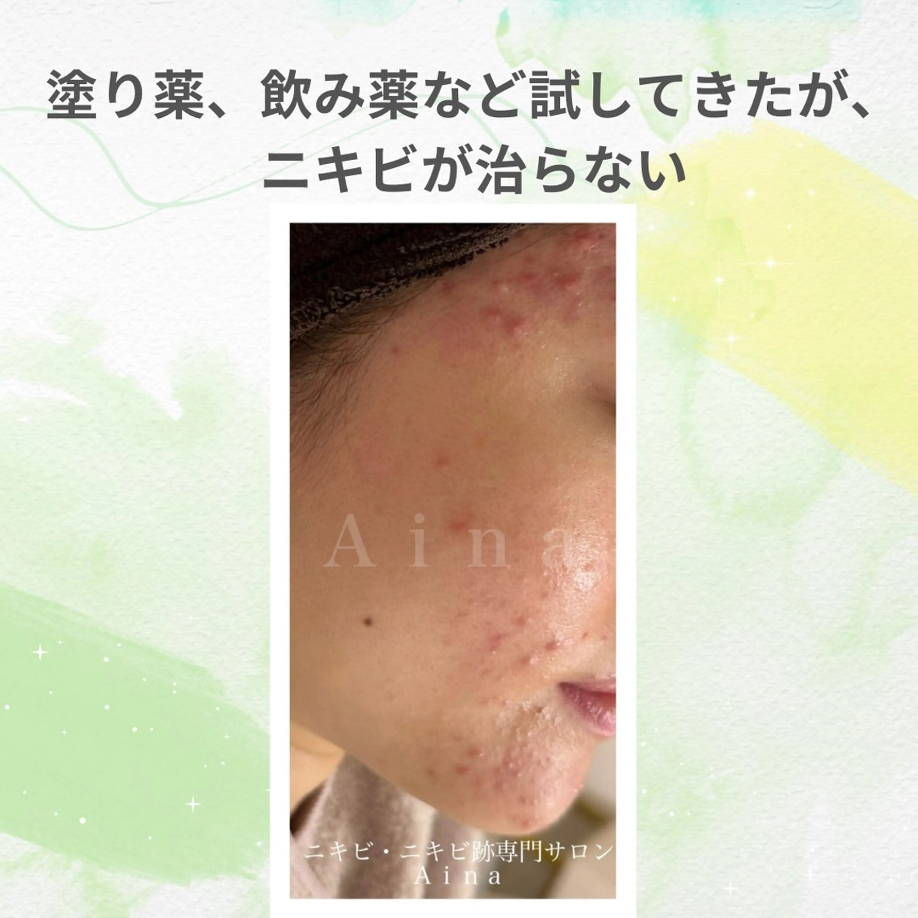 エステ リラク ニキビ跡専門サロン Ainaのエステ・リラクイメージ