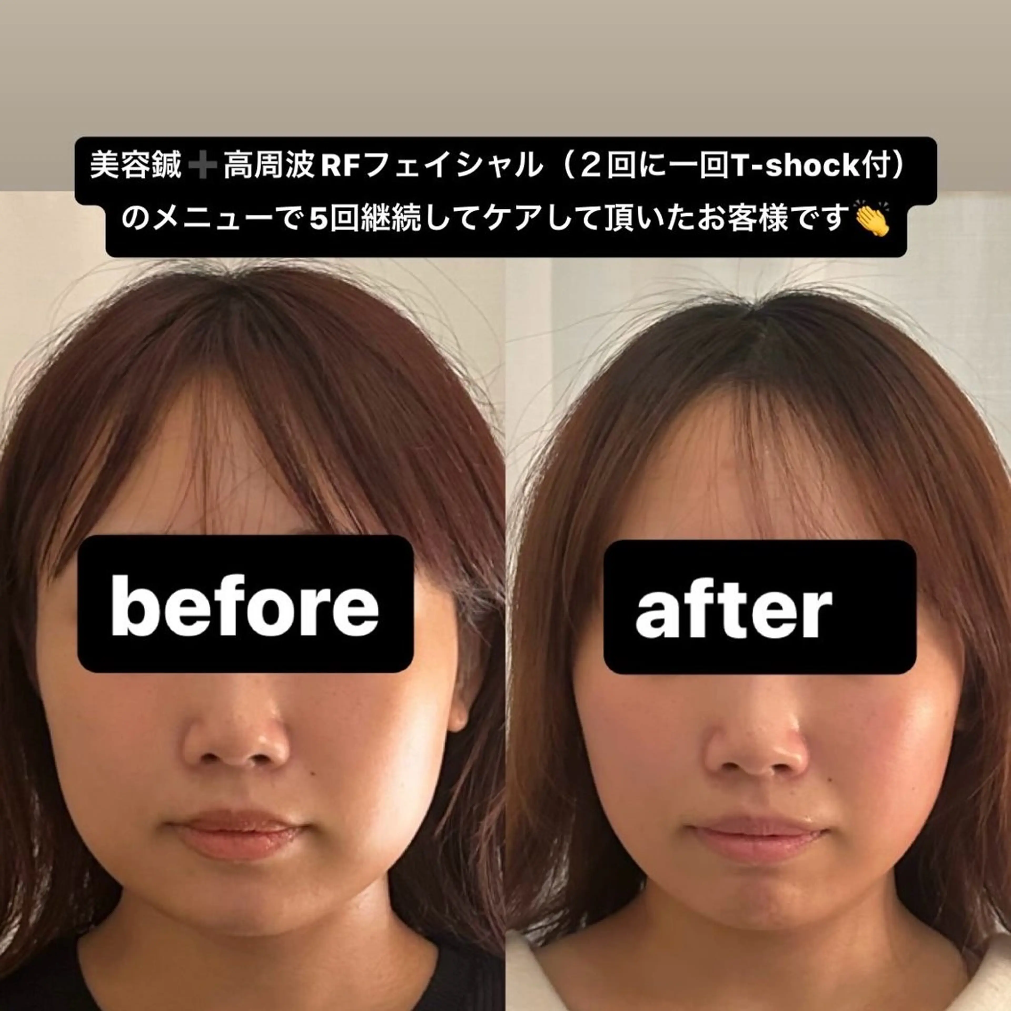その他 美容鍼WINBACK サロンRemeのエステ・リラクイメージ