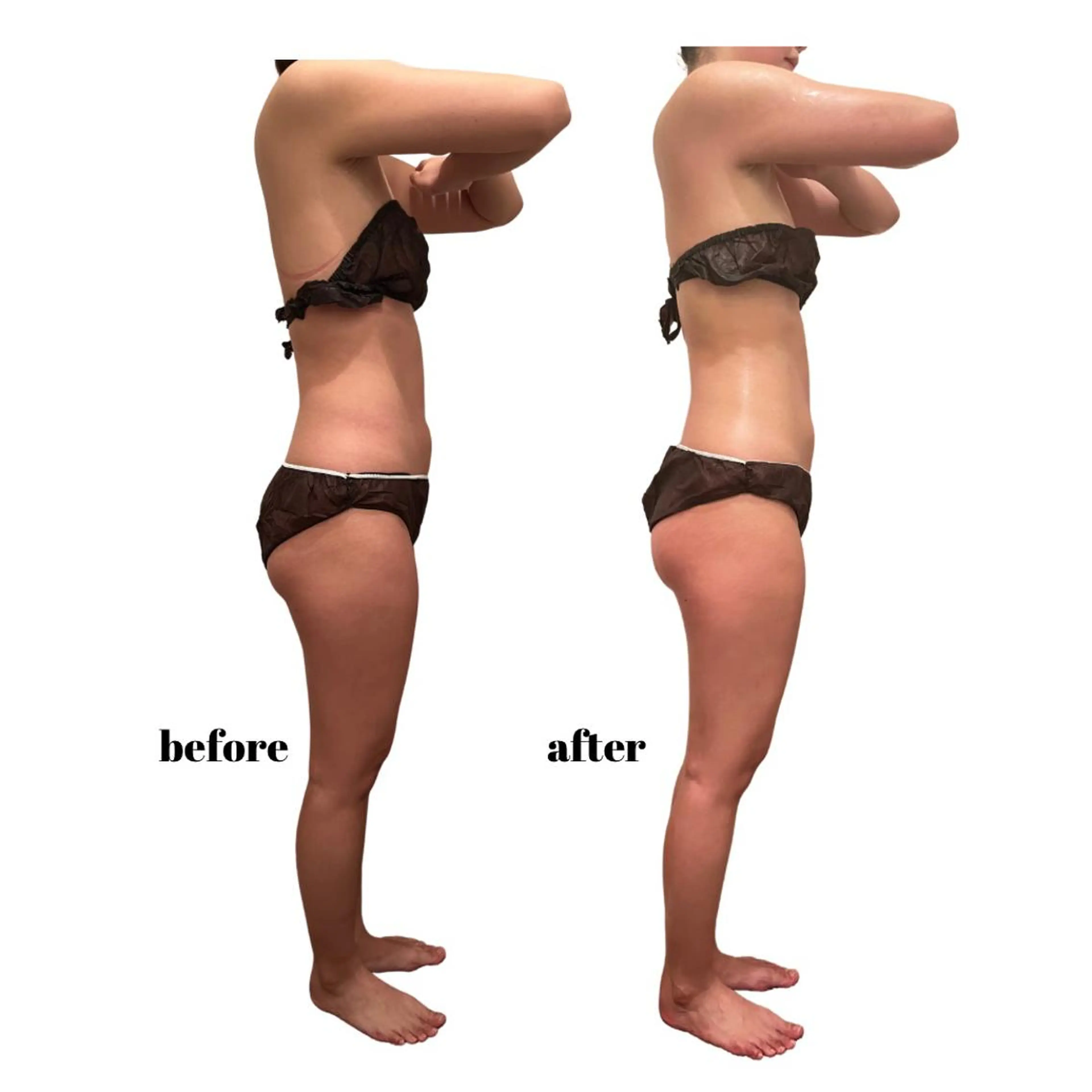 🍔本気で痩せたい人に🍔最新機器『セルライトゼロ』の写真