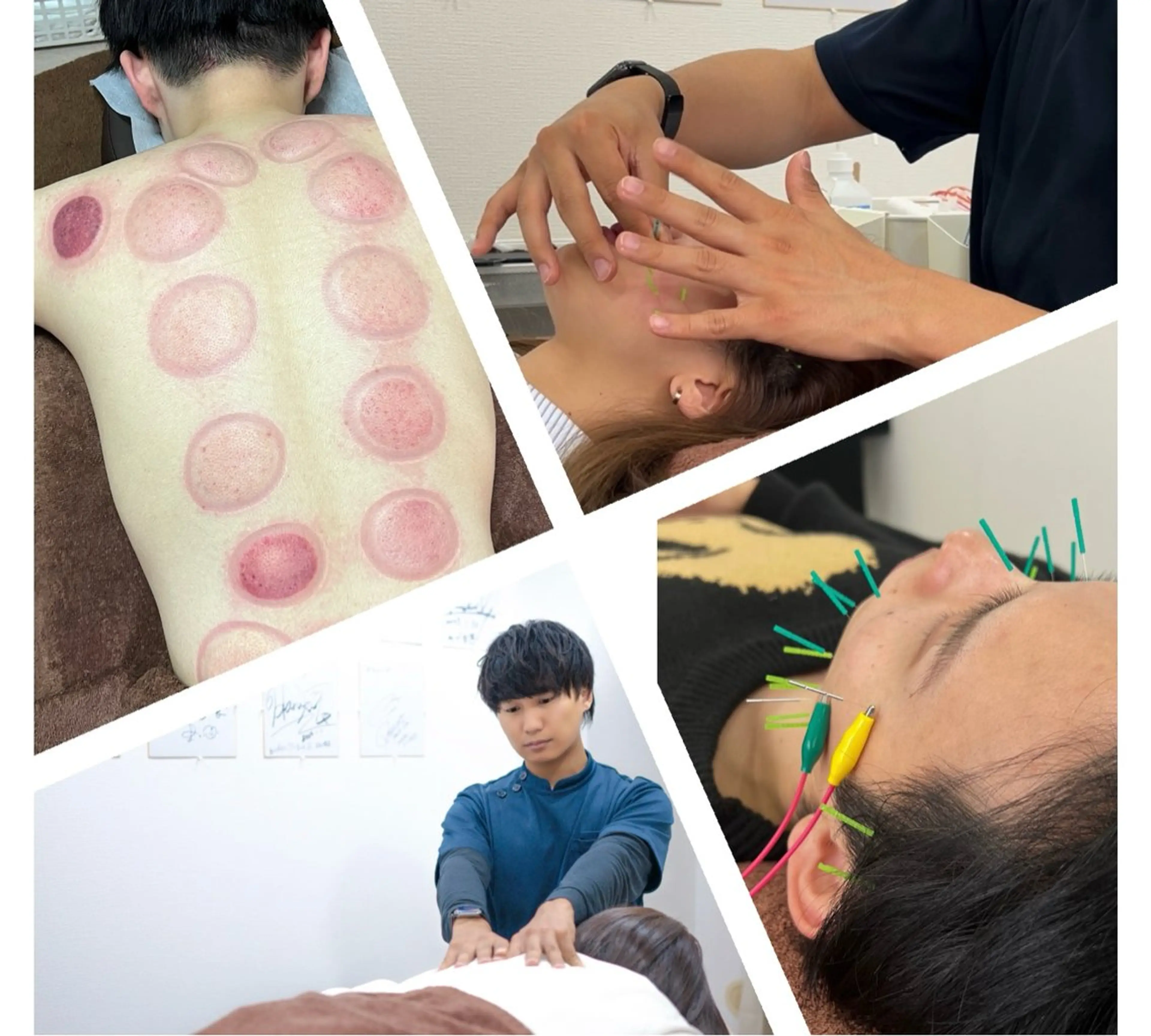 美容鍼×小顔×猫背× ブライダル 大阪梅田のエステ・リラクイメージ