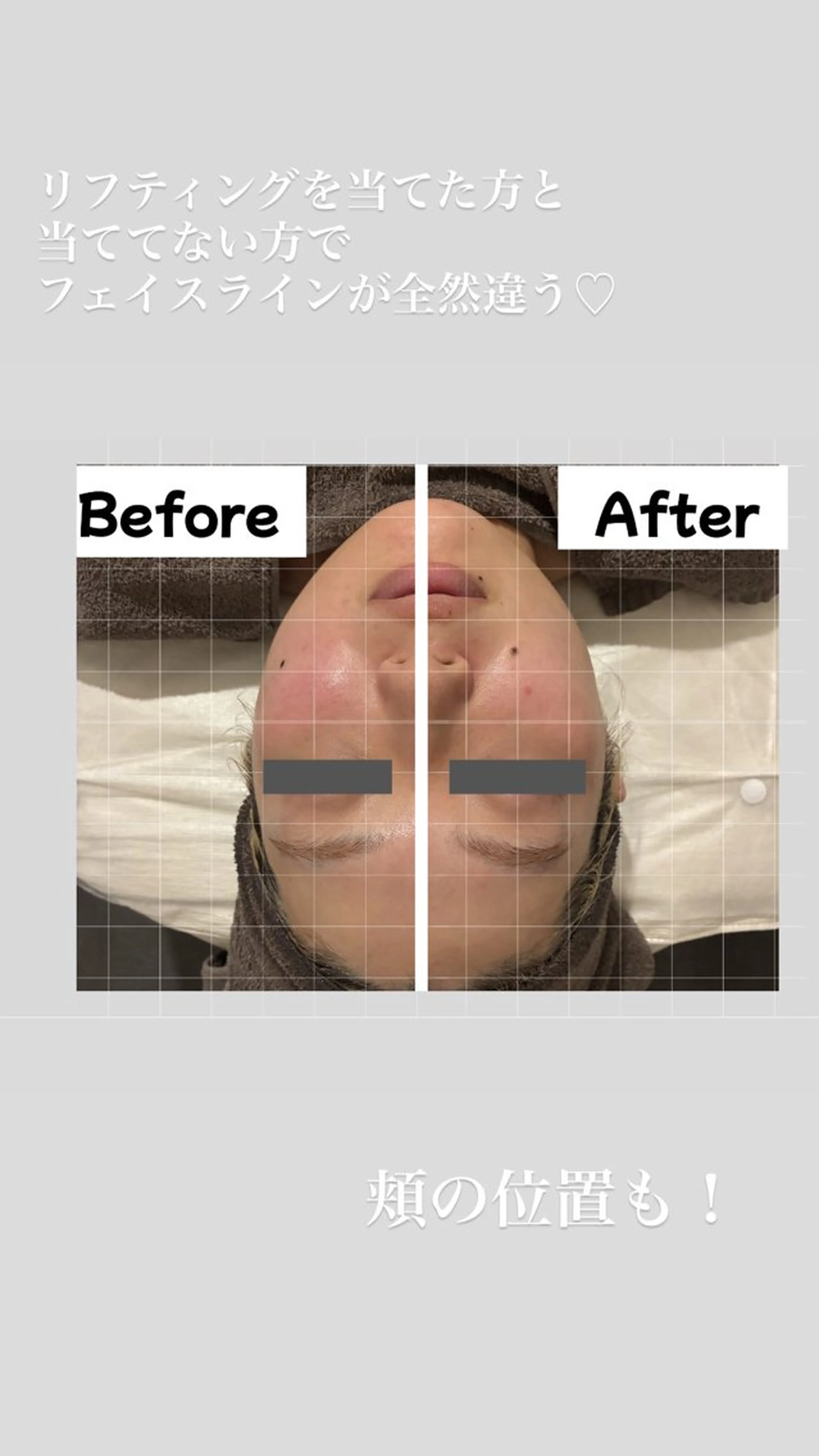 【ほうれい線/たるみ/小顔】フェイスライン崩れにアプローチ◎立体小顔60分の写真