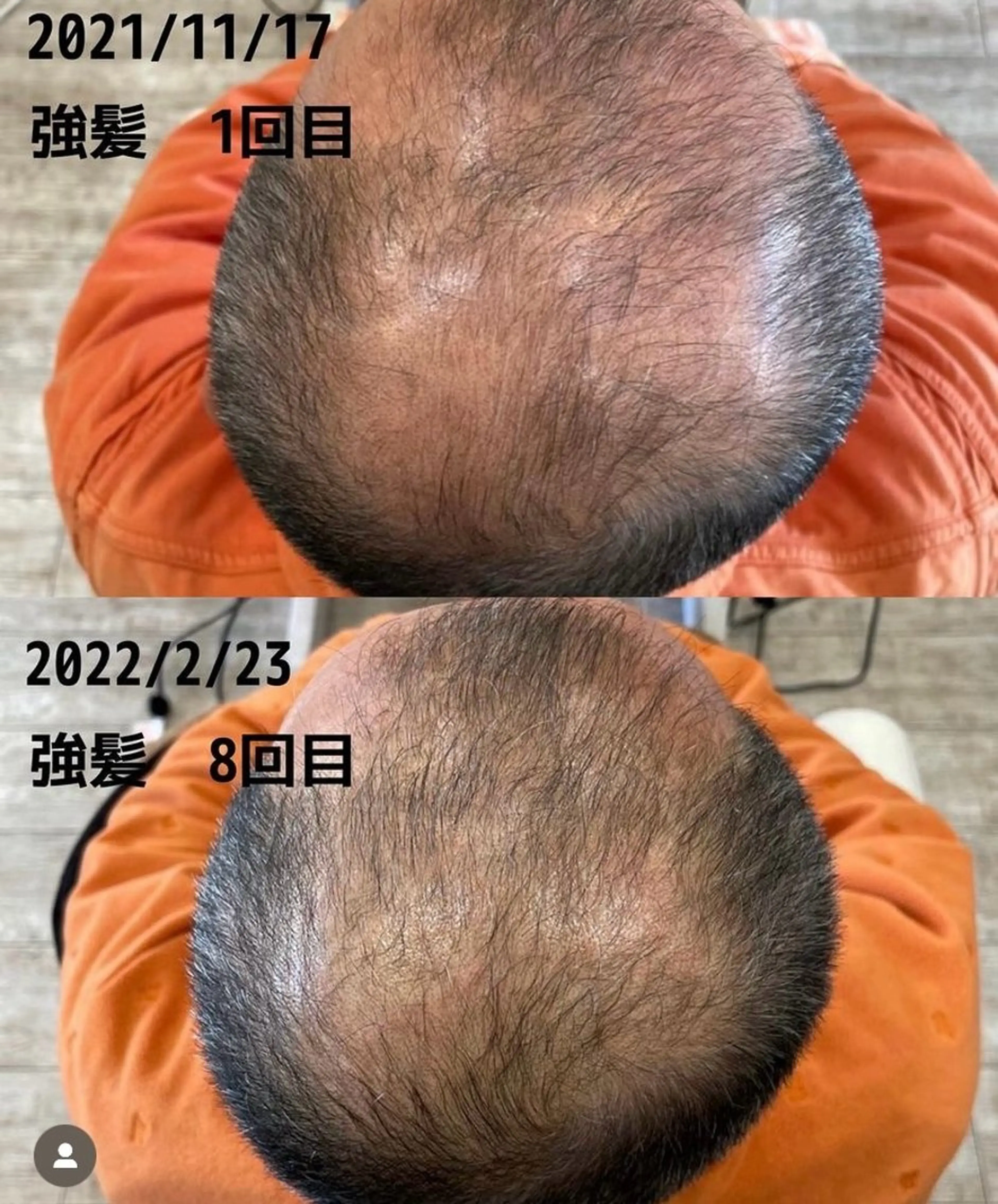 メンズ 分け目・つむじ 自然増毛専門のヘアスタイル