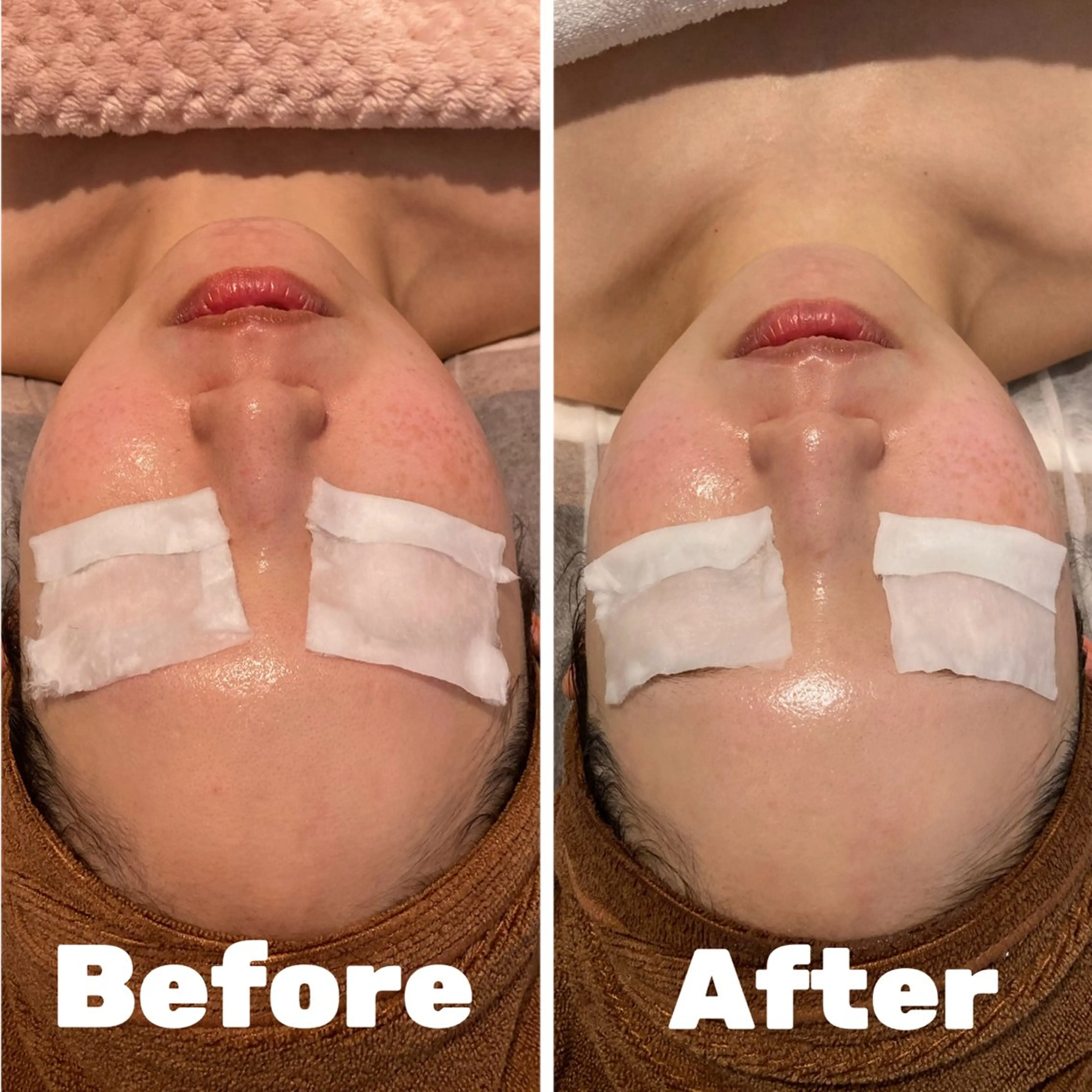 光フォト+リフトアップマッサージの写真