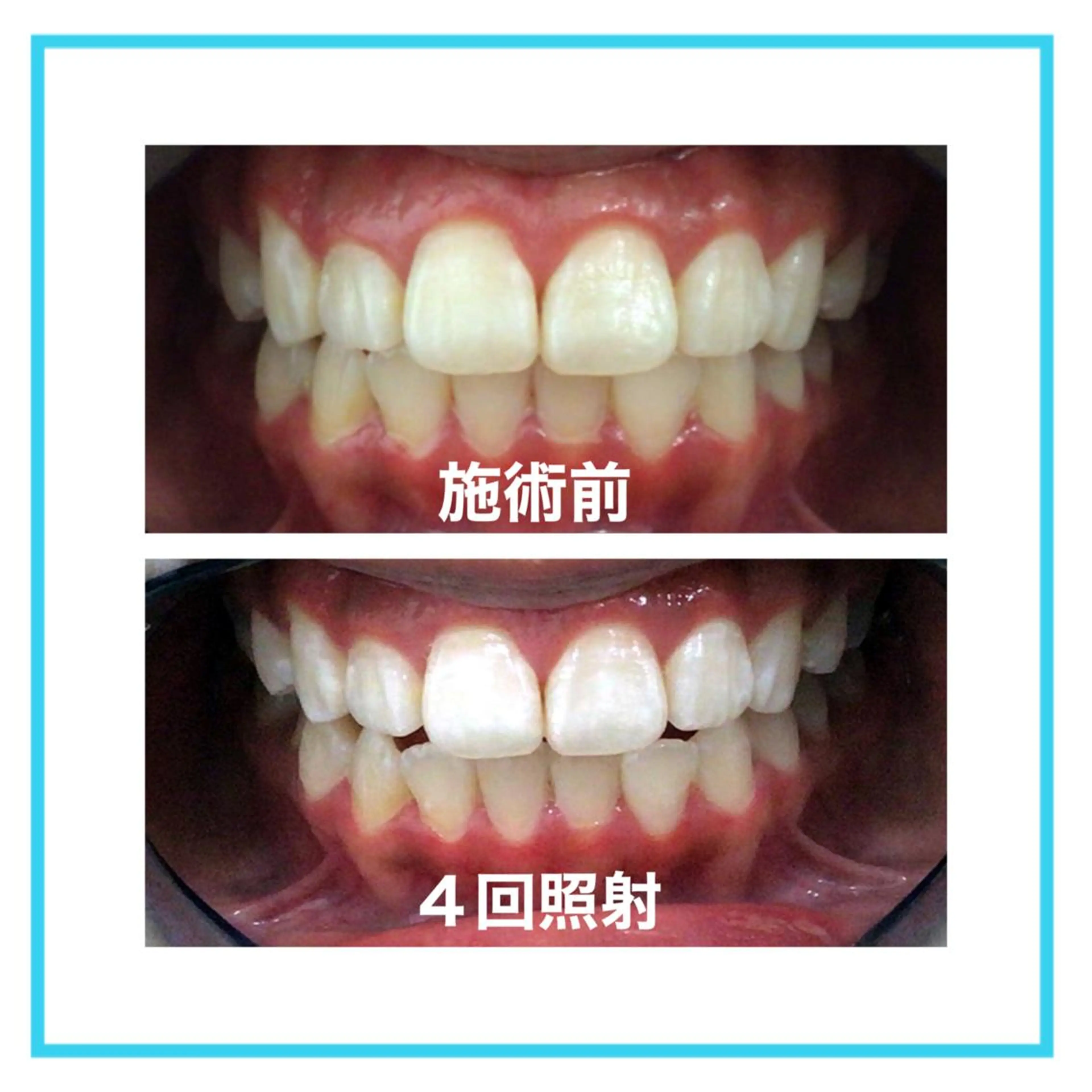 ✨ご新規様minimo限定✨歯のセルフホワイトニング８分×4回照射　(施術時間60分)の写真