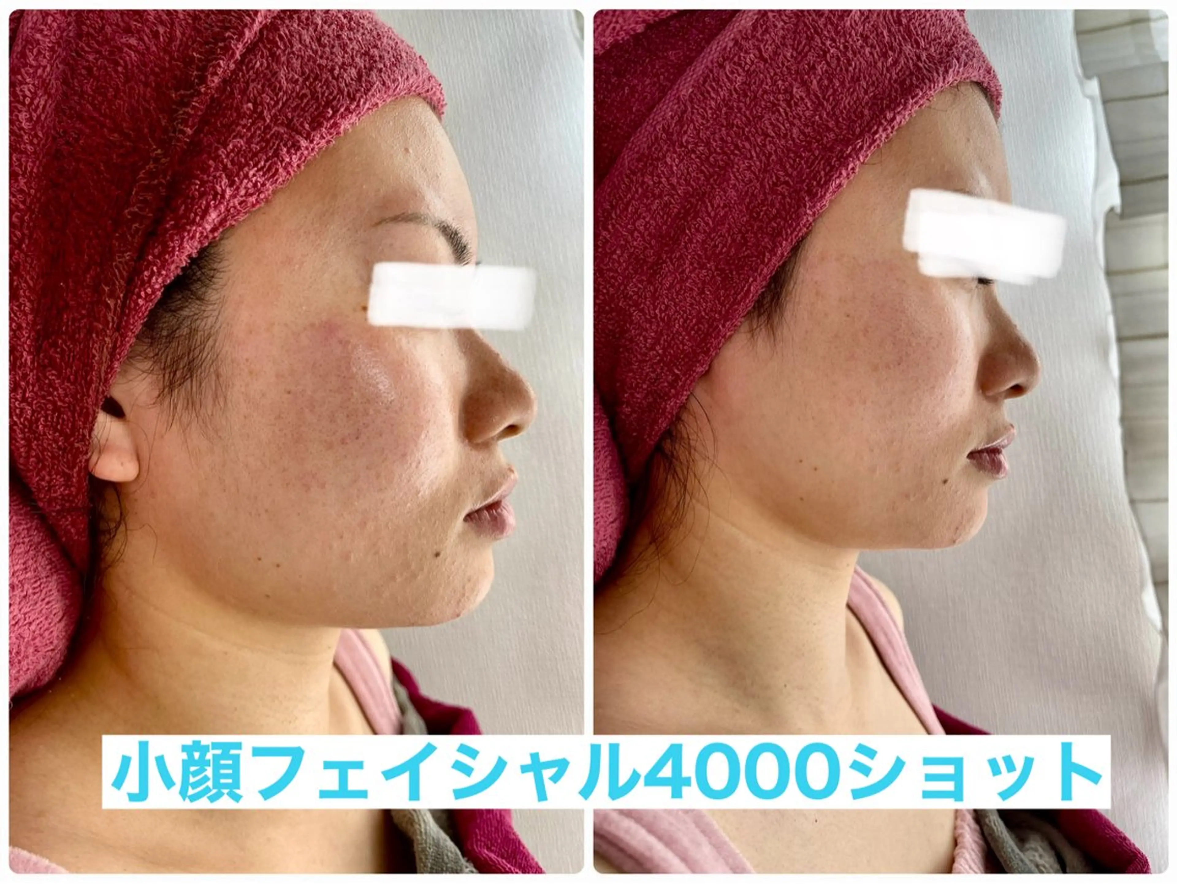 エステ REVI取扱・肌悩み 毛穴Chalonのエステ・リラクイメージ