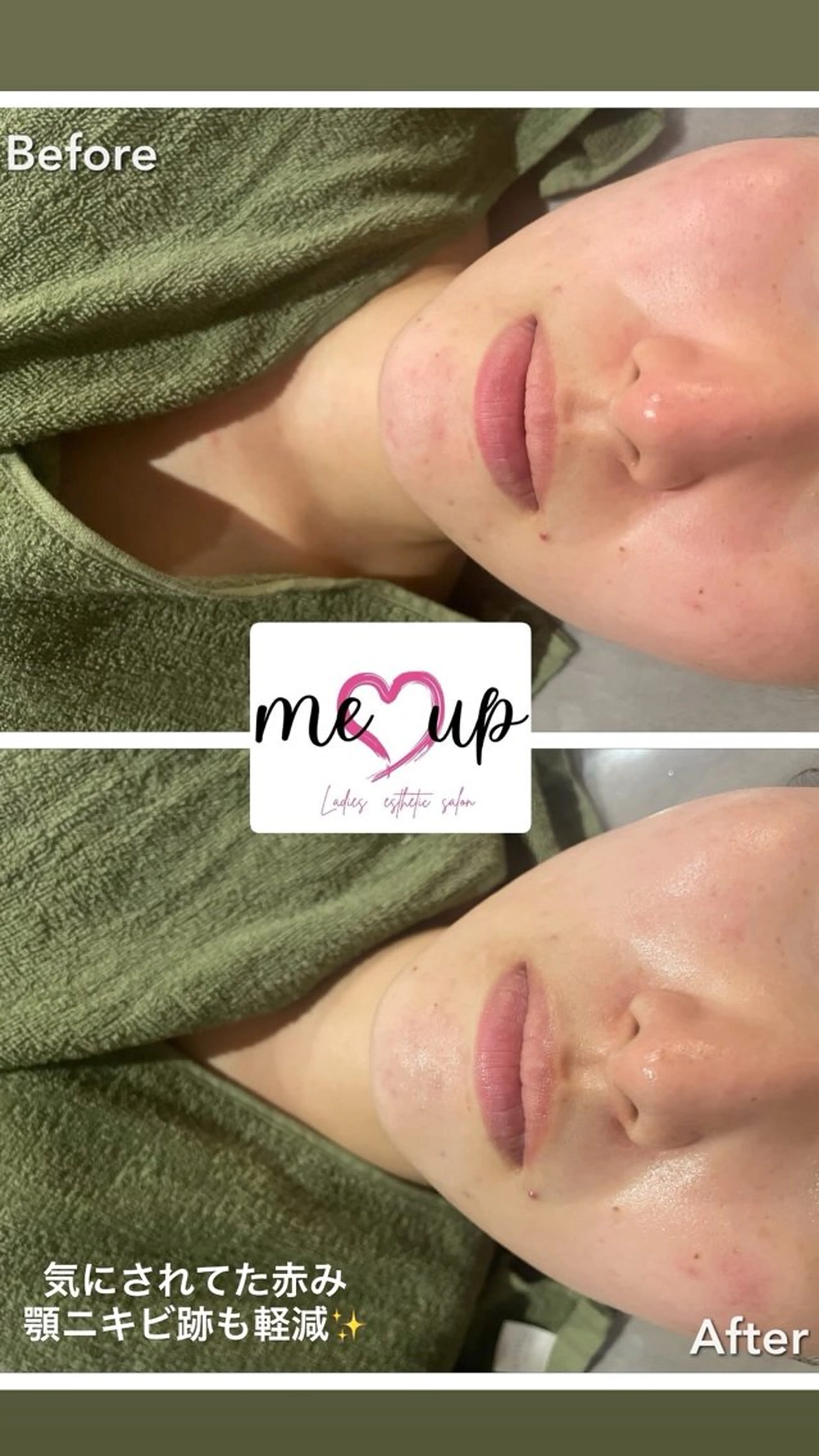 Meupニキビ専門店 背中/ハーブ/肌管理のその他イメージ