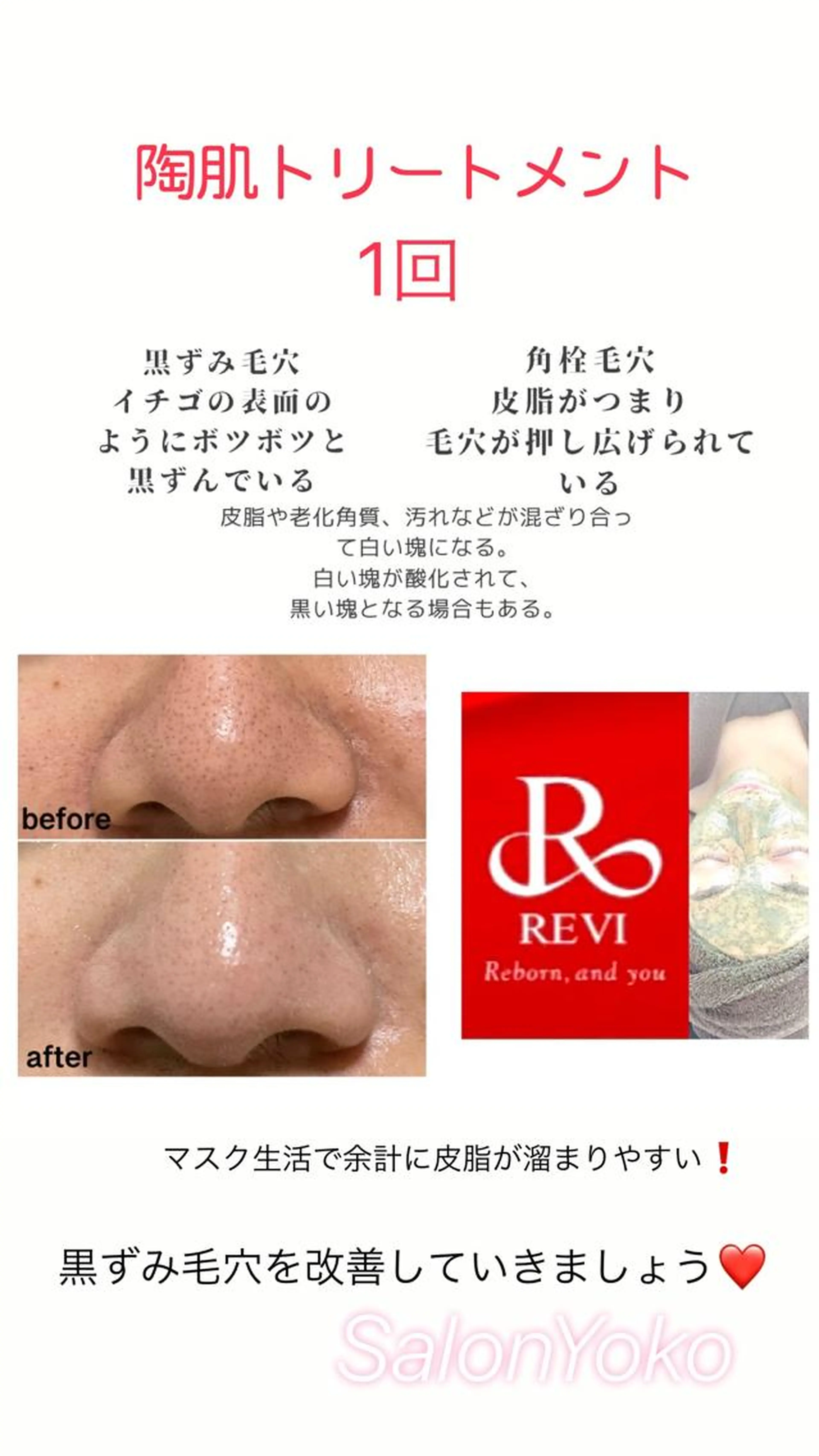 どなたでも◎【毛穴、ニキビケア】REVI🌹陶肌トリートメント🌿80分の写真