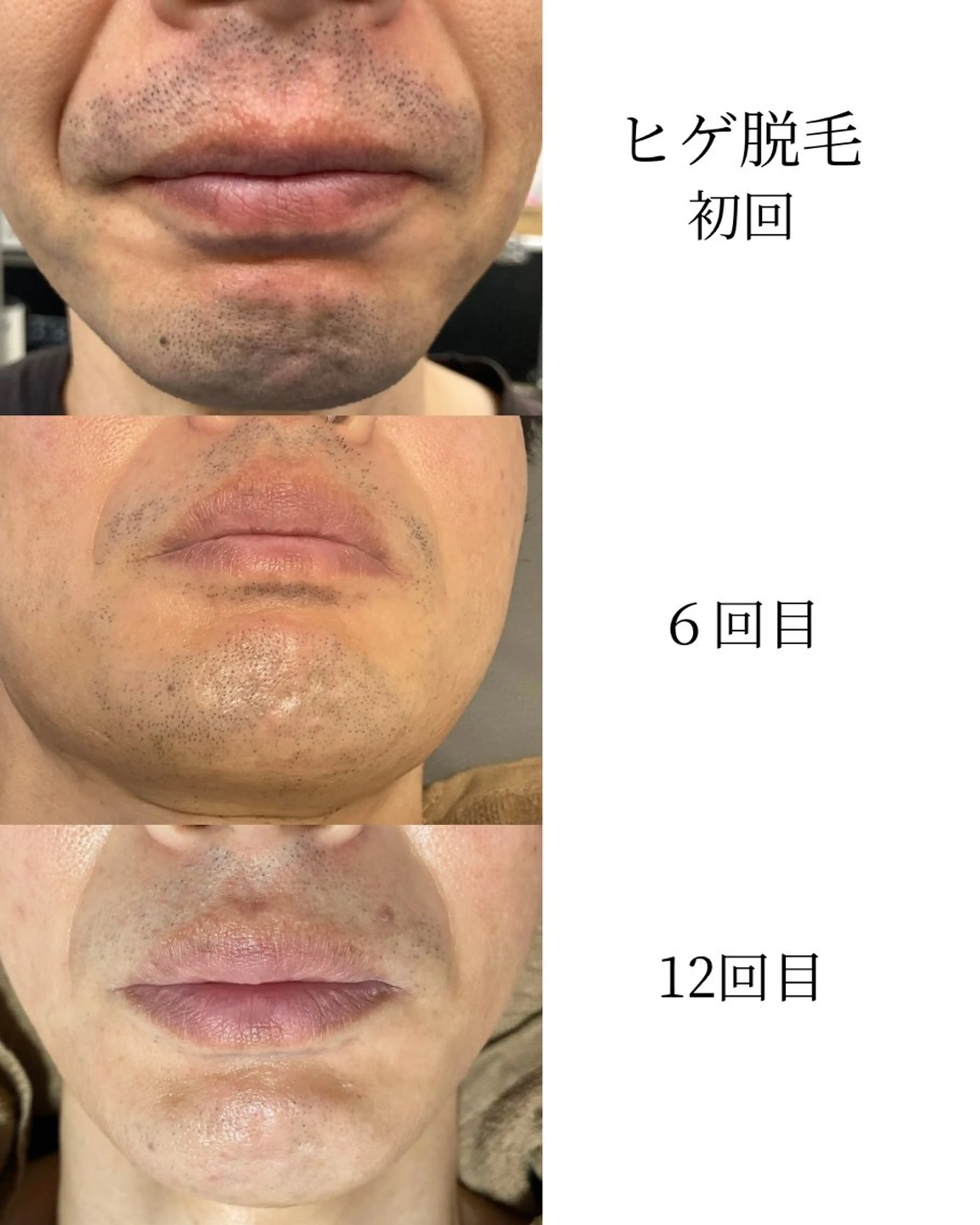 メンズ 脱毛 ビューティーサロン ベクスト名古屋のマツエク・マツパデザイン