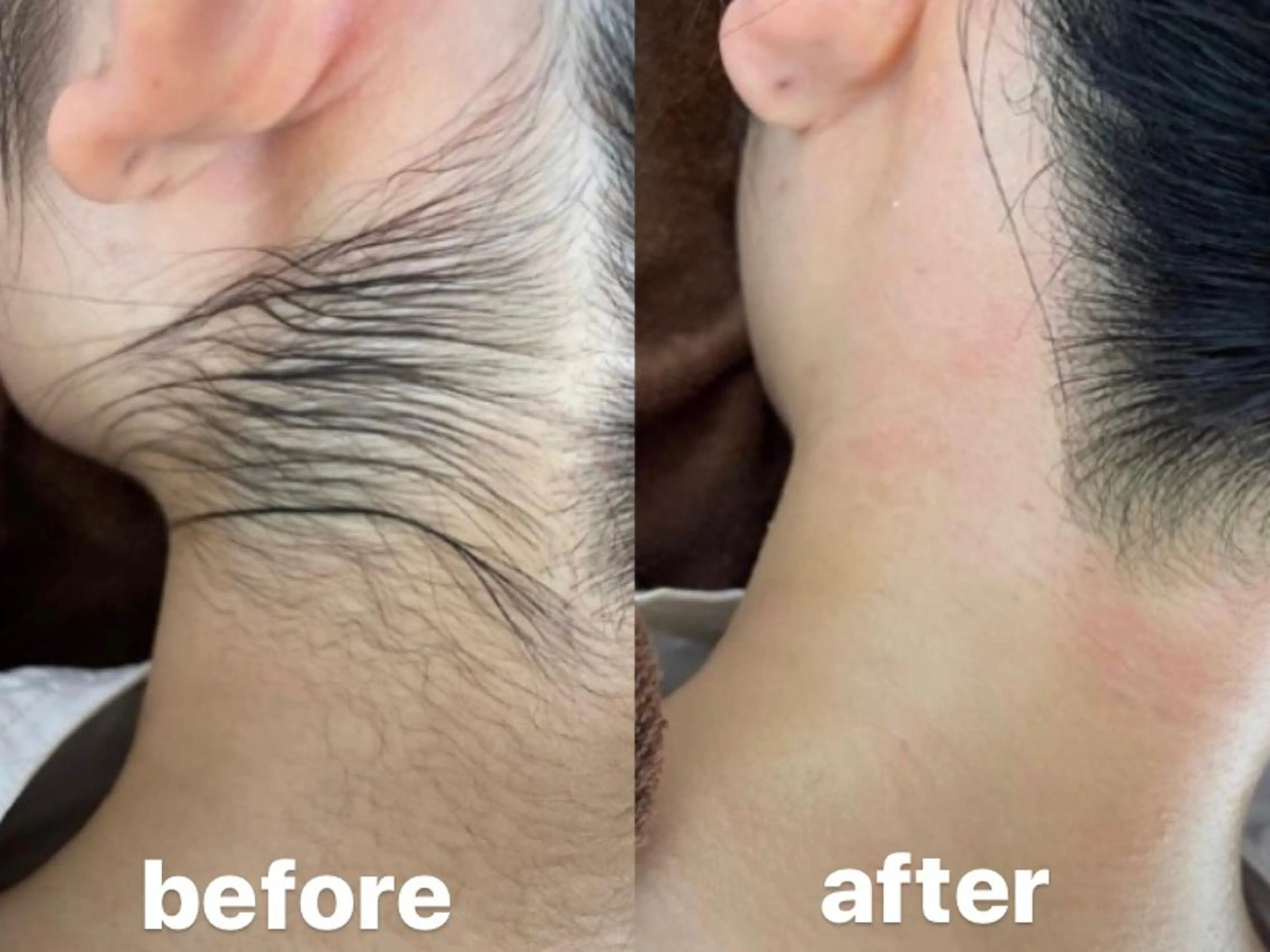 襟足・うなじWax✨✨浴衣やドレスの時のヘアアップスタイルも気にならない✨✨の写真