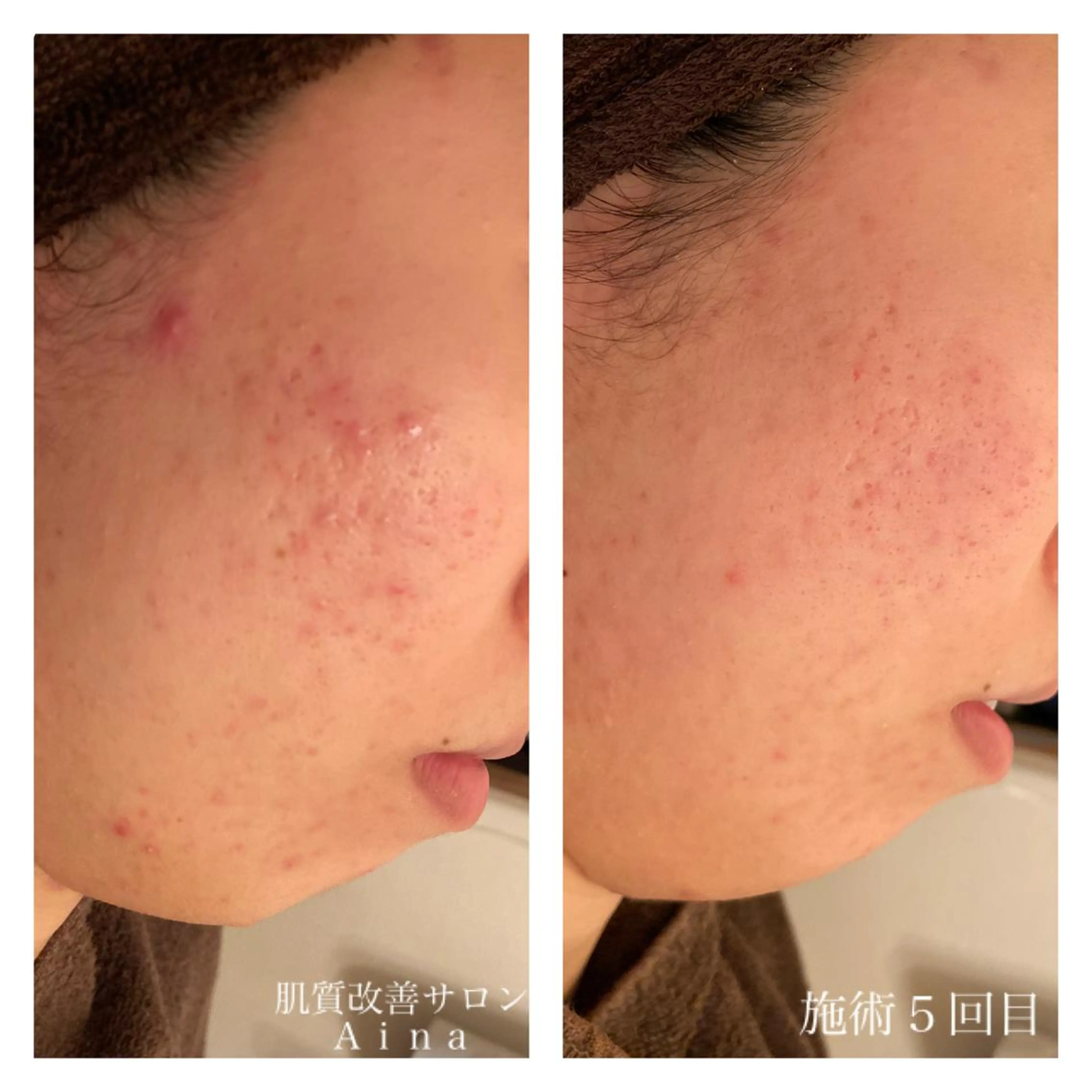 ロング カラー パーマ ヘアアレンジ メンズ キッズ ネイル マツエク・マツパ 赤色 エステ リラク ニキビ跡専門サロン Ａｉｎａのエステ・リラクイメージ