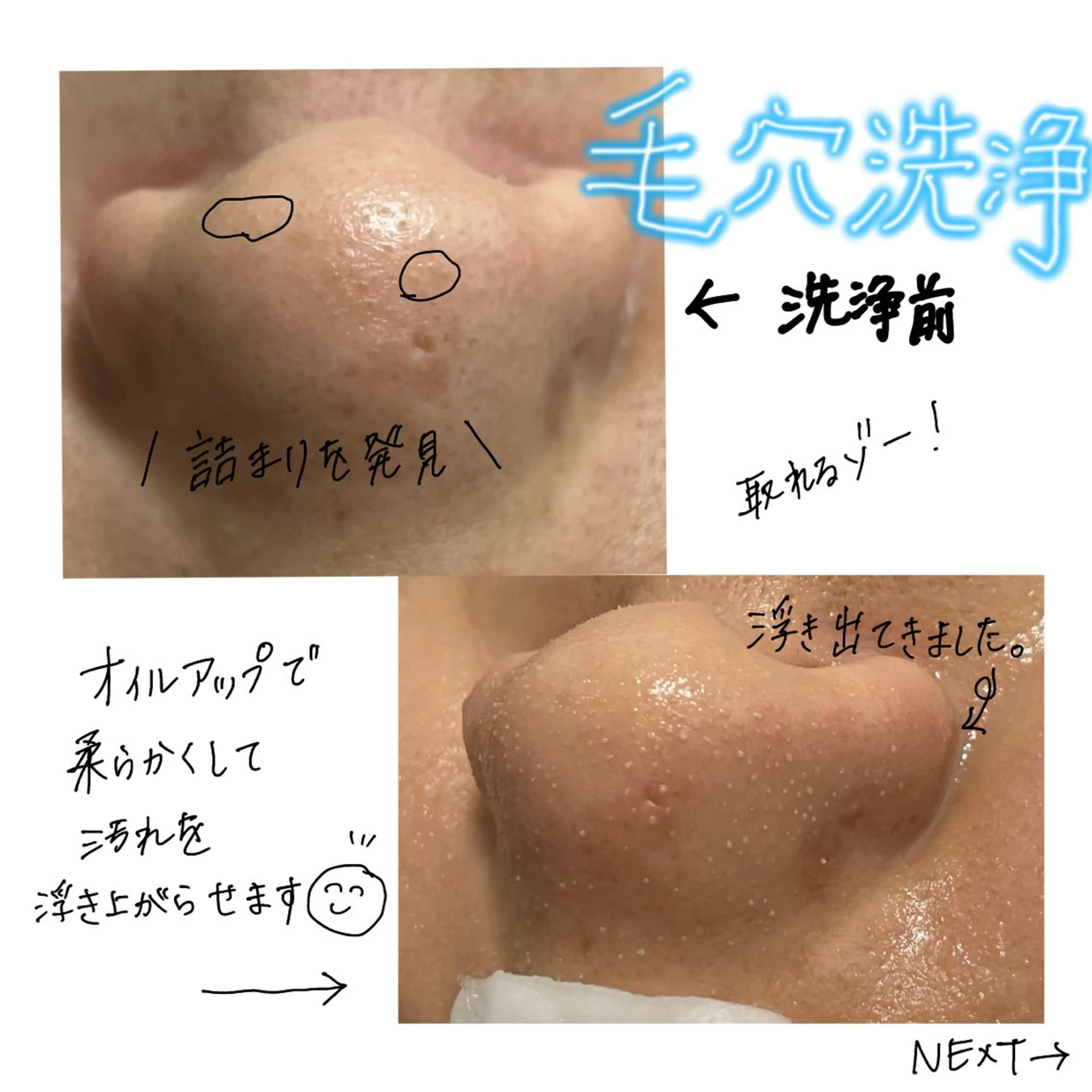 毛穴洗浄の写真