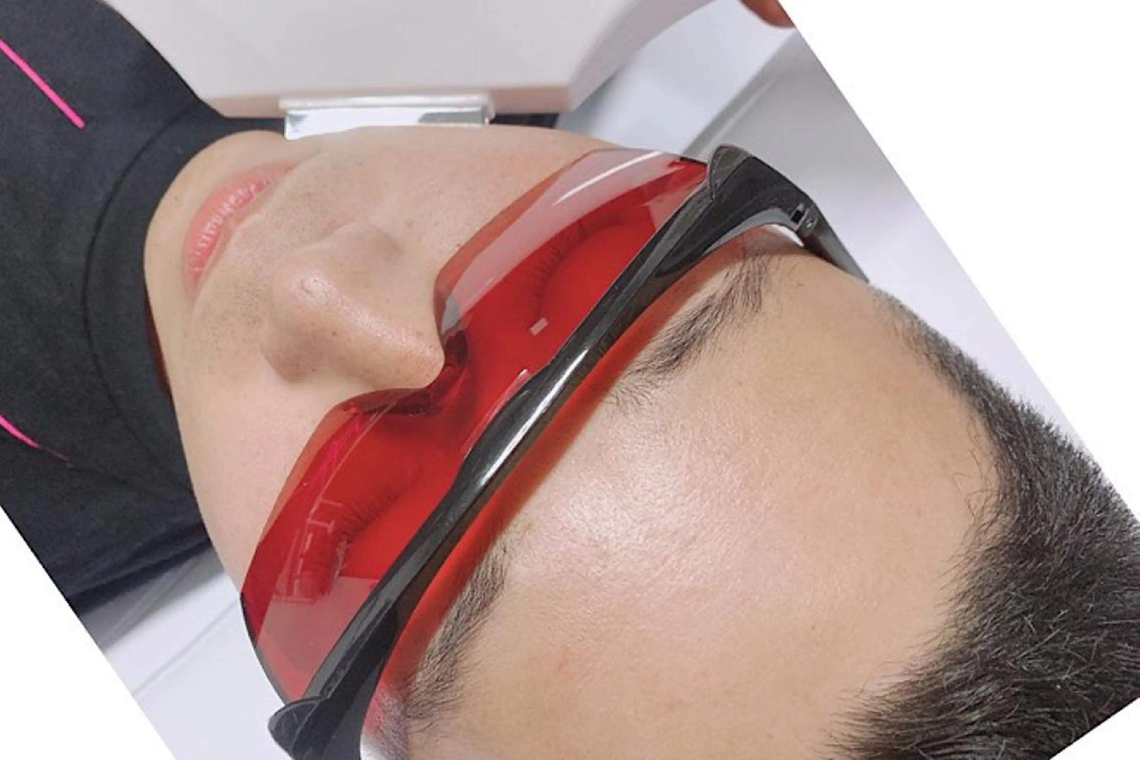 ヒゲ脱毛（顔全体）の写真