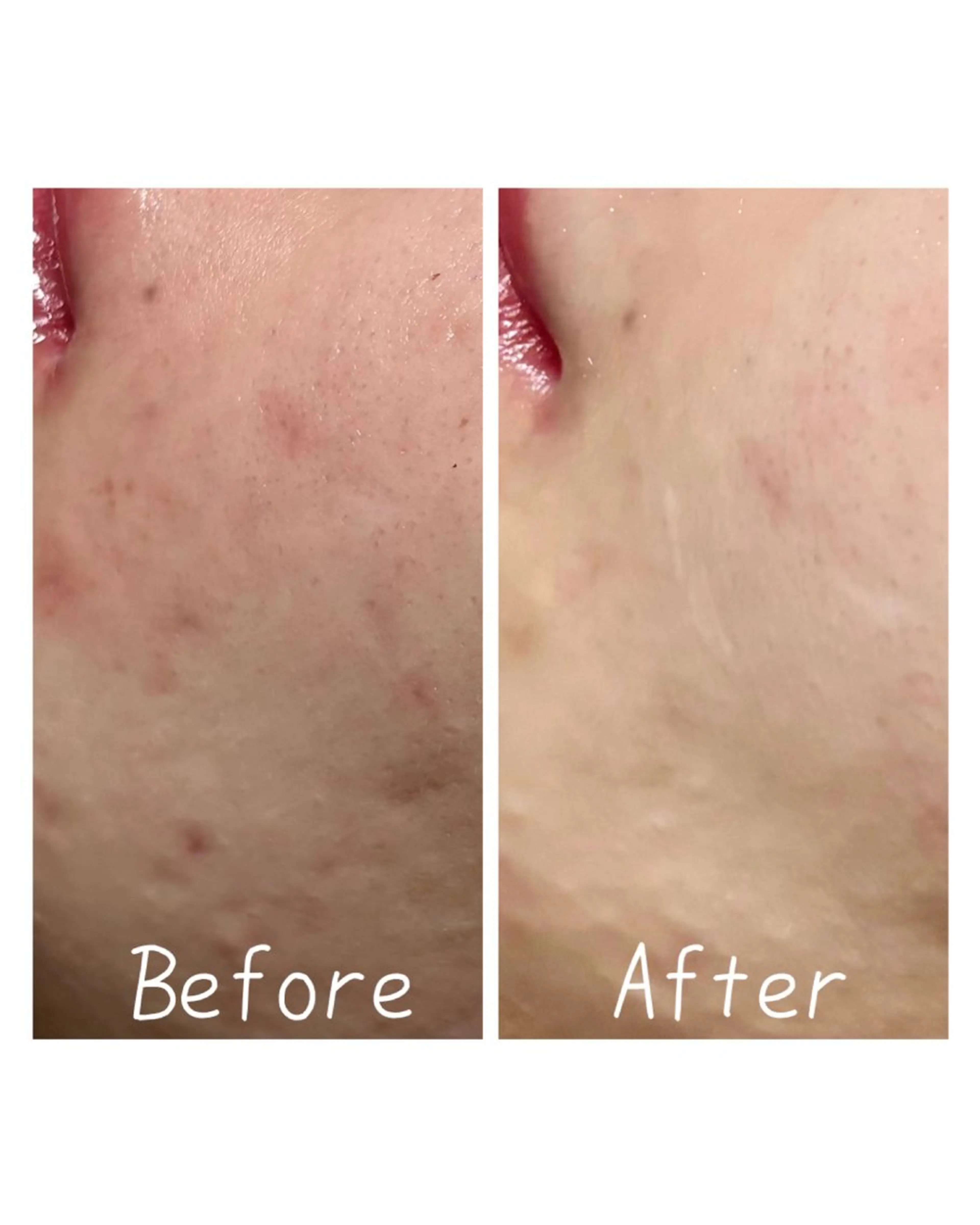 エステ Charme coco(シャルム ココ)八尾店所属・ニキビ 毛穴ケア シャルム ココ みさのエステ・リラクイメージ