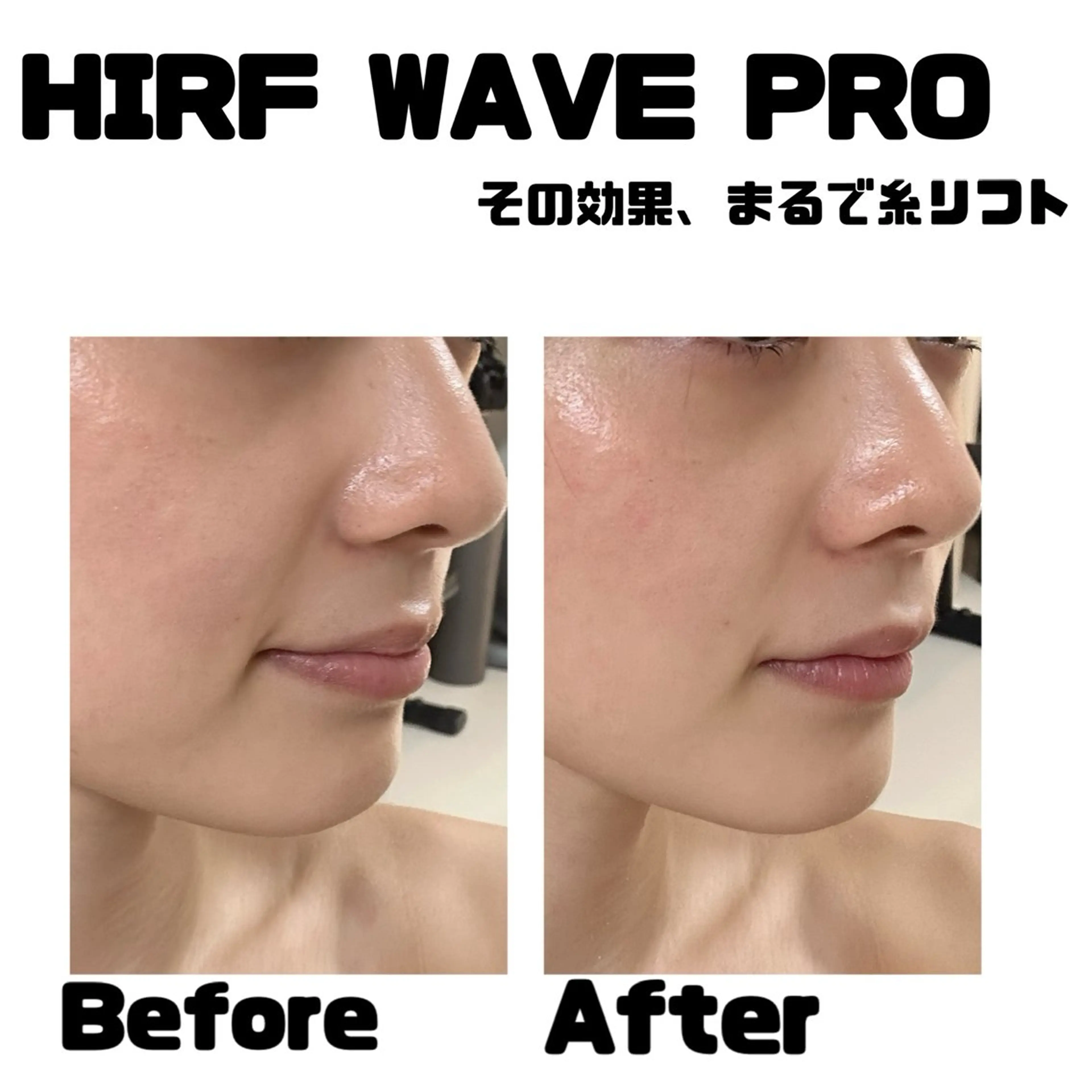 期間限定価格❣️エステ版ソフウェーブ【HIRF WAVE PRO】全顔・顎下・首の写真