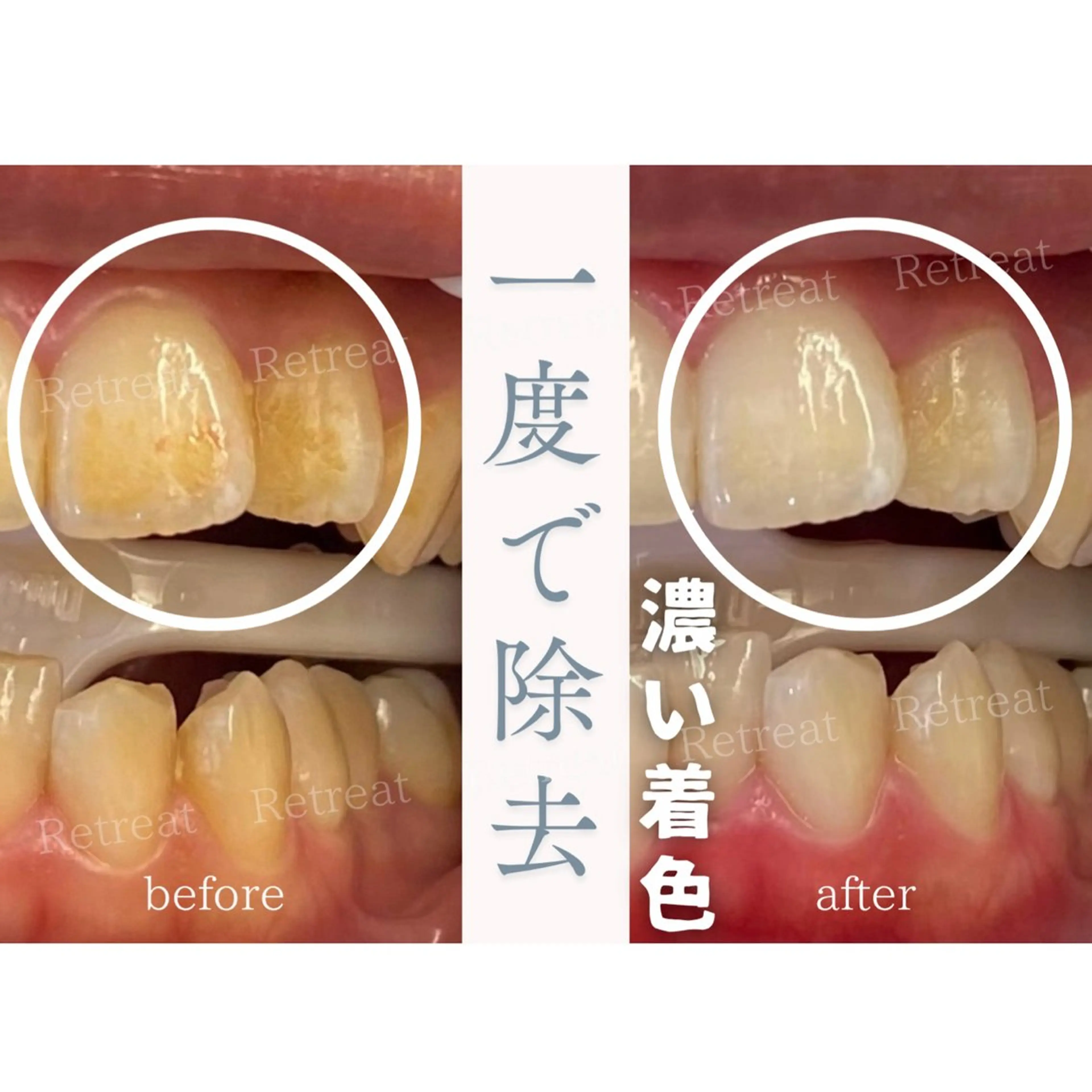 医療ホワイトニング4回照射の写真