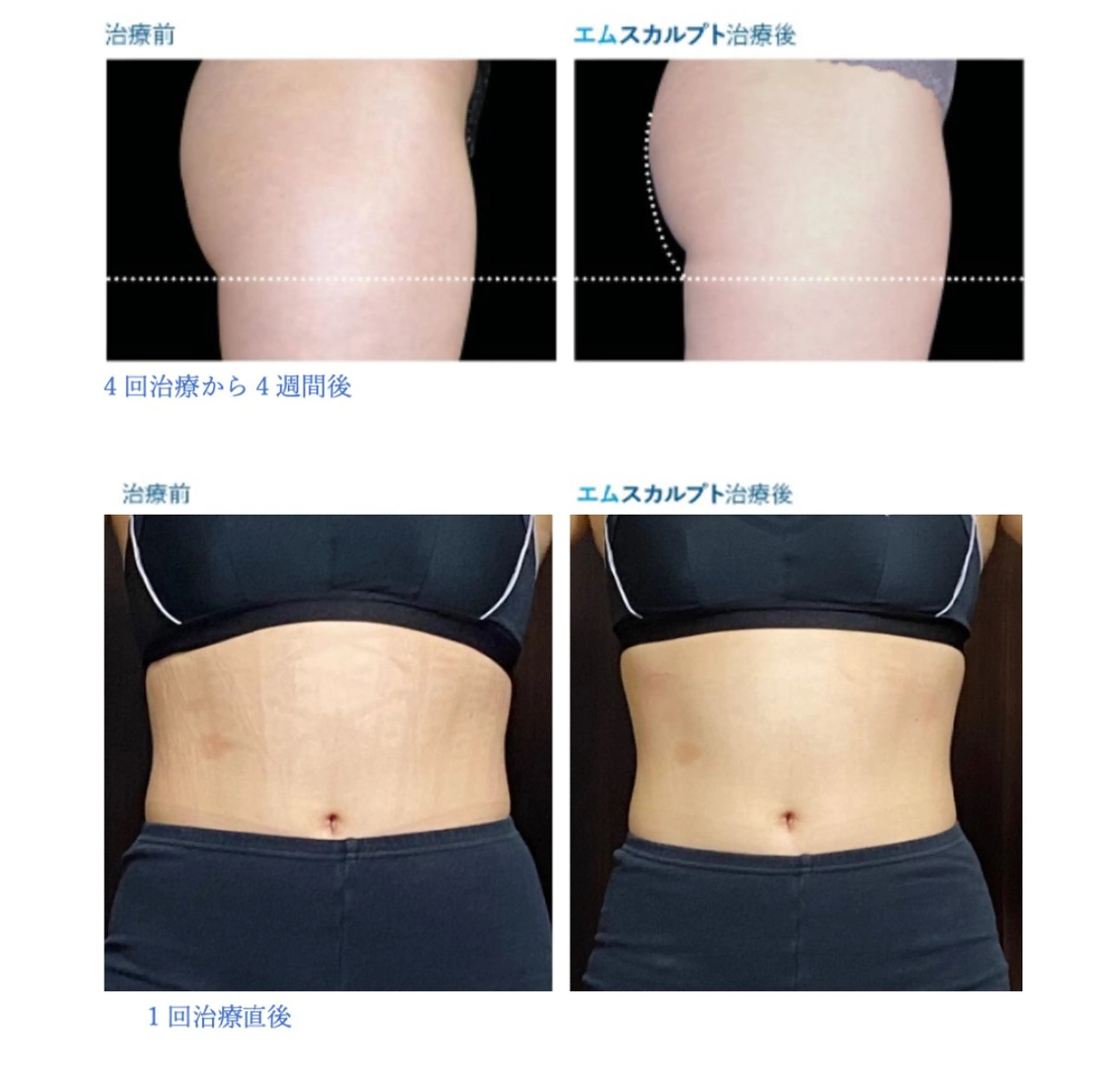 【夏までに痩せたい方必見】次の日には筋肉痛🔥エムスカルプト痩身エステの写真